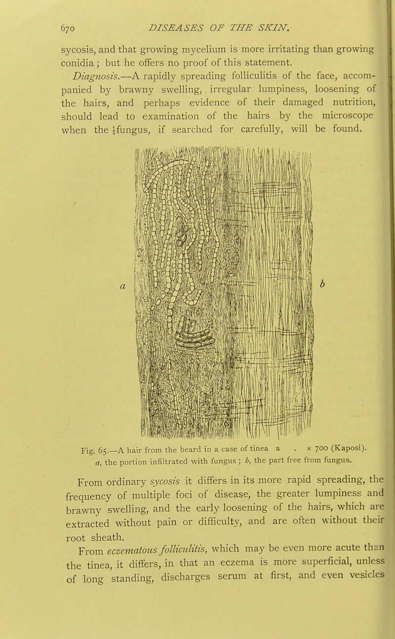 sycosis, and that growing mycelium is more irritating than growing conidia ; but he offers no proof of this statement. Diagnosis.—A rapidly spreading folliculitis of the face, accom- panied by brawny swelling, irregular lumpiness, loosening of the hairs, and perhaps evidence of their damaged nutrition, should lead to examination of the hairs by the microscope when the 5fungus, if searched for carefully, will be found. Fig. 65.—A hair from the beard in a case of tinea a . x 700 (Kaposi). a, the portion infiltrated with fungus ; b, the part free from fungus. From ordinary sycosis it differs in its more rapid spreading, the frequency of multiple foci of disease, the greater lumpiness and brawny swelling, and the early loosening of the hairs, which are extracted without pain or difficulty, and are often without their root sheath. From eczematous folliculitis, which may be even more acute than the tinea, it differs, in that an eczema is more superficial, unless of long standing, discharges serum at first, and even vesicles