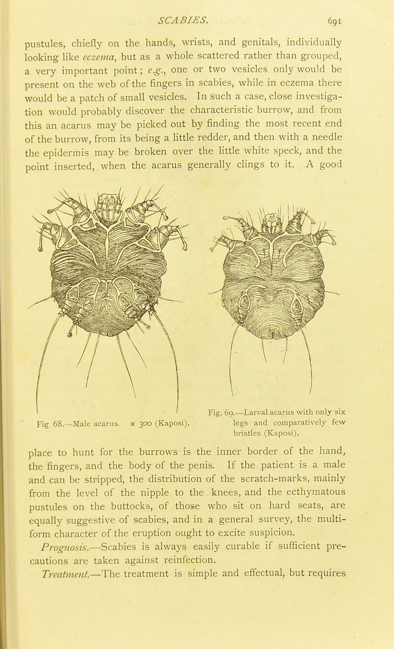 pustules, chiefly on the hands, wrists, and genitals, individually looking like eczema, but as a whole scattered rather than grouped, a very important point; e.g., one or two vesicles only would be present on the web of the fingers in scabies, while in eczema there would be a patch of small vesicles. In such a case, close investiga- tion would probably discover the characteristic burrow, and from this an acarus may be picked out by finding the most recent end of the burrow, from its being a little redder, and then with a needle the epidermis may be broken over the little white speck, and the point inserted, when the acarus generally clings to it. A good Fig. 69.—Larval acarus with only six Fig 68.—Male acarus. x 300 (Kaposi). legs and comparatively few bristles (Kaposi). place to hunt for the burrows is the inner border of the hand, the fingers, and the body of the penis. If the patient is a male and can be stripped, the distribution of the scratch-marks, mainly from the level of the nipple to the knees, and the ecthymatous pustules on the buttocks, of those who sit on hard seats, are equally suggestive of scabies, and in a general survey, the multi- form character of the eruption ought to excite suspicion. Prognosis.—Scabies is always easily curable if sufficient pre- cautions are taken against reinfection. Treatment.—The treatment is simple and effectual, but requires