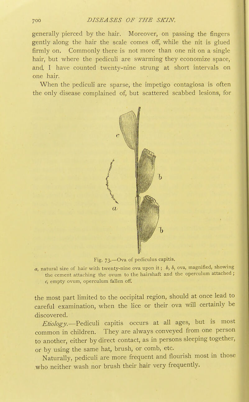 generally pierced by the hair. Moreover, on passing the fingers gently along the hair the scale comes off, while the nit is glued firmly on. Commonly there is not more than one nit on a single hair, but where the pediculi are swarming they economize space, and. I have counted twenty-nine strung at short intervals on one hair. When the pediculi are sparse, the impetigo contagiosa is often the only disease complained of, but scattered scabbed lesions, for Fig. 73.—Ova of pediculus capitis. a, natural size of hair with twenty-nine ova upon it; b, b, ova, magnified, showing the cement attaching the ovum to the hairshaft and the operculum attached ; c, empty ovum, operculum fallen off. the most part limited to the occipital region, should at once lead to careful examination, when the lice or their ova will certainly be discovered. Etiology.—Pediculi capitis occurs at all ages, but is most common in children. They are always conveyed from one person to another, either by direct contact, as in persons sleeping together, or by using the same hat, brush, or comb, etc. Naturally, pediculi are more frequent and flourish most in those who neither wash nor brush their hair very frequently.