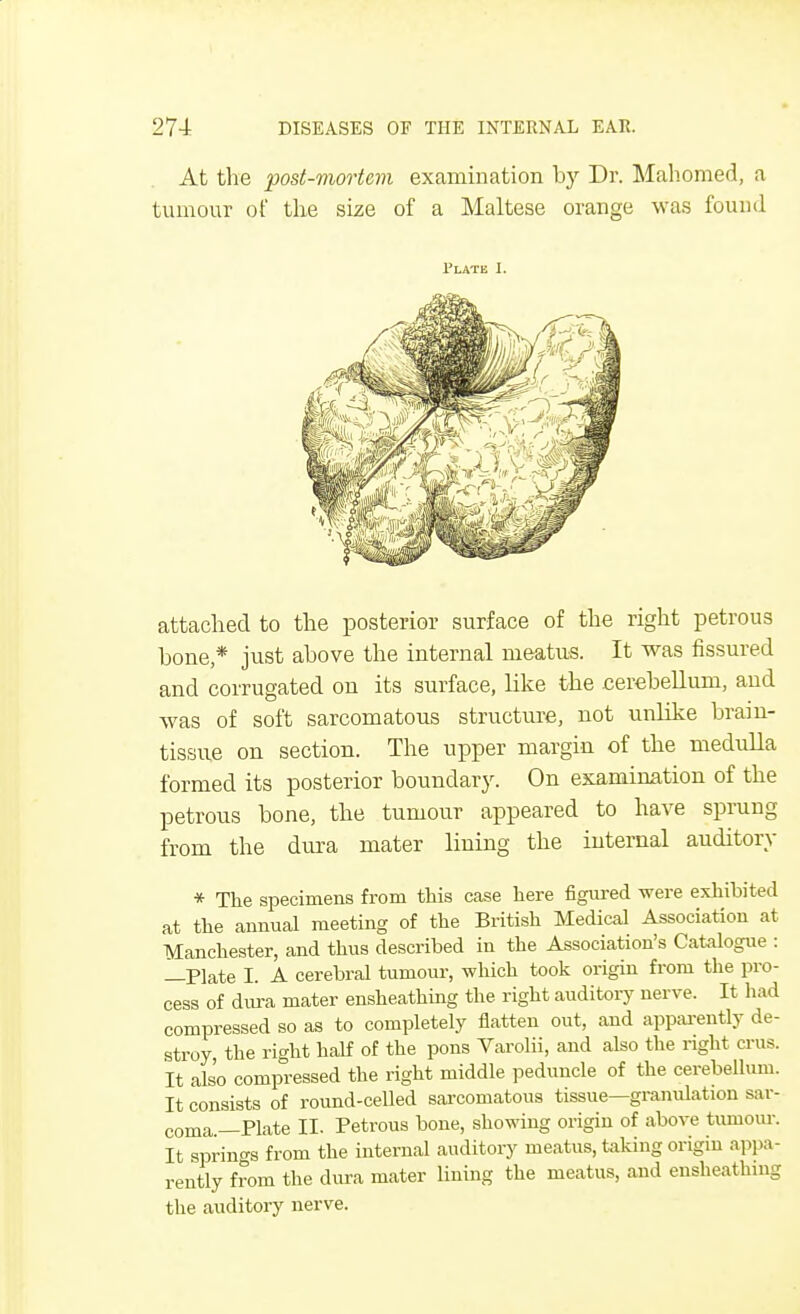 At the post-mortem examination by Dr. Mahomed, a tumour of the size of a Maltese orange was found 1'late I. attached to the posterior surface of the right petrous bone * just above the internal meatus. It was fissured and corrugated on its surface, like the cerebellum, and was of soft sarcomatous structure, not unlike brain- tissue on section. The upper margin of the medulla formed its posterior boundary. On examination of the petrous bone, the tumour appeared to have sprung from the dura mater lining the internal auditory * The specimens from this case here figured were exhibited at the annual meeting of the British Medical Association at Manchester, and thus described in the Association's Catalogue : —Plate I. A cerebral tumour, which took origin from the pro- cess of dura mater ensheathing the right auditory nerve. It had compressed so as to completely flatten out, and apparently de- stroy the right half of the pons Varolii, and also the right crus. It also compressed the right middle peduncle of the cerebellum. It consists of round-celled sarcomatous tissue—granulation sar- coma —Plate II. Petrous bone, showing origin of above tumour. It springs from the internal auditory meatus, taking origin appa- rently from the dura mater lining the meatus, and ensheathing the auditory nerve.
