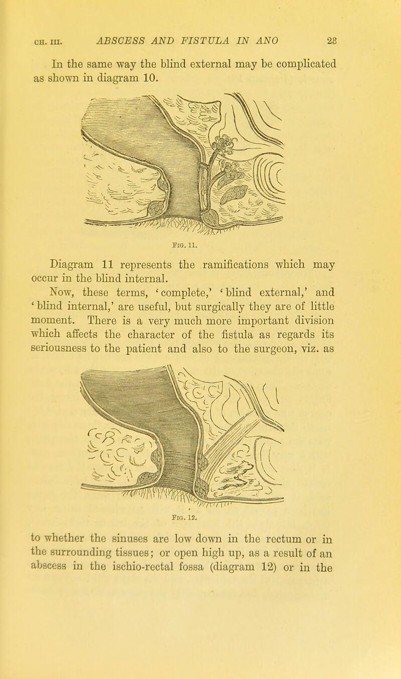 In the same way the blind external may be complicated as shown ia diagi'am 10. Fig. 11. Diagi-am 11 represents the ramifications which may occur in the blind internal. Now, these terms, 'complete,' 'blind external,' and * blind internal,' are useful, but surgically they are of little moment. There is a very much more important division which affects the character of the fistula as regards its seriousness to the patient and also to the surgeon, viz. as Fio. 12. to whether the sinuses are low down in the rectum or in the surrounding tissues; or open high up, as a result of an abscess in the iachio-rectal fossa (diagi-am 12) or in the