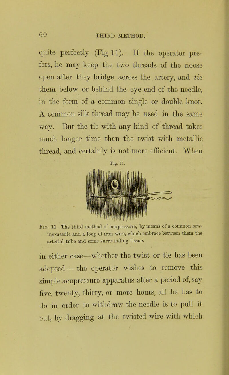 quite perfectly (Fig 11). If the operator pre- fers, lie may keep the two threads of the noose open after they bridge across the artery, and tie them below or behind the eye-end of the needle, in the form of a common single or double knot. A common silk thread may be used in the same way. But the tie with any kind of thread takes much longer time than the twist with metallic thread, and certainly is not more efficient. When Fig. 11. Fig. 11. The third method of acupressui-e, by means of a common sew- ing-needle and a loop of iron-wii-e, which embrace betAveen them the arterial tube and some suiTOunding tissue. in either case—whether the twist or tie has been adopted — the operator wishes to remove this simple acupressure apparatus after a period of, say five, twenty, thirty, or more hours, all he has to do in order to withdraw the needle is to pull it out, by di-agging at the twisted wire with which