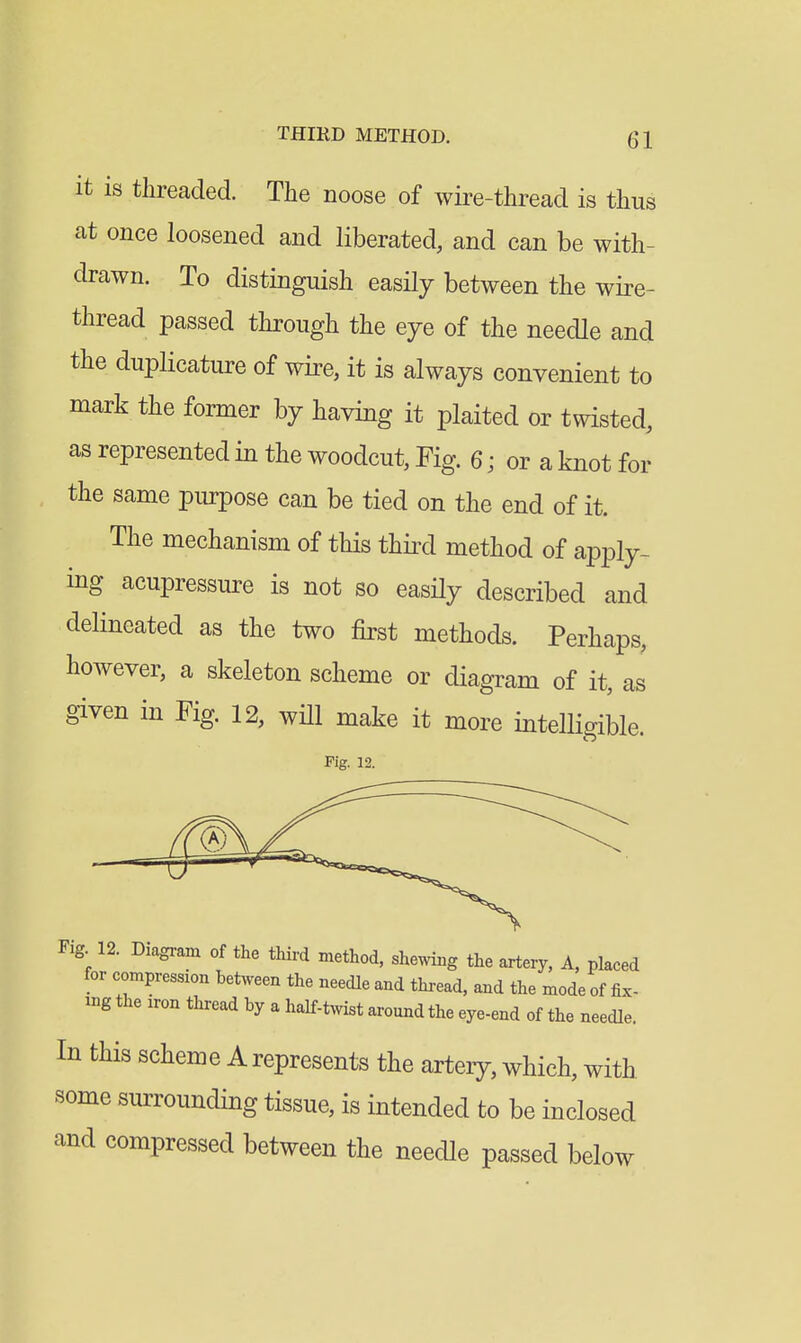 it is threaded. The noose of wire-thread is thus at once loosened and liberated, and can be with- drawn. To distinguish easily between the wire- thread passed through the eye of the needle and the duplicature of wire, it is always convenient to mark the former by having it plaited or twisted, as represented in the woodcut, Fig. 6; or a knot for the same purpose can be tied on the end of it. The mechanism of this third method of apply- ing acupressure is not so easily described and delineated as the two first methods. Perhaps, however, a skeleton scheme or diagram of it, as given in Fig. 12, will make it more intelligible. Pig. 12. Fig 12. Diagram of the third method, shewing the artery, A, placed for compression between the needle and thi-ead, and the mode of fix- ing the iron thread by a half-twist around the eye-end of the needle. In this scheme A represents the arteiy, which, with some smTounding tissue, is intended to be inclosed and compressed between the needle passed below