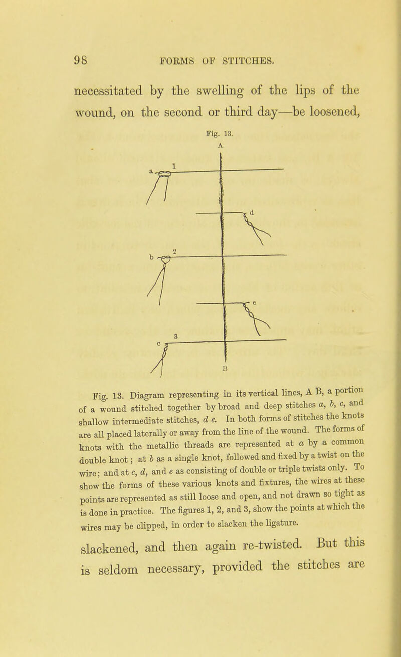 necessitated by the swelling of the lips of the wound, on the second or third day—be loosened, Fig. 13. A Fig. 13. Diagram representing in its vertical lines, A B, a portion of a wound stitched together by broad and deep stitches a, h, c, and shallow intermediate stitches, d e. In both forms of stitches the knots are aU placed lateraUy or away from the line of the wound. The forms of knots with the metallic threads are represented at a by a common double knot; at & as a single knot, foUowed and fixed by a twist on the wire; and at c, d, and e as consisting of double or triple twists only. To show the forms of these various knots and fixtures, the Avires at these points are represented as still loose and open, and not draAvn so tight as is done in practice. The figures 1, 2, and 3, show the points at which the wires may be clipped, in order to slacken the ligatiu-e. slackened, and then again re-twisted. But this is seldom necessary, provided the stitches are