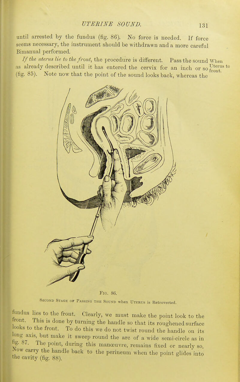 until arrested by the fundus (fig. 86). No force is needed. If force seems necessary, the instrument should be withdrawn and a more careful Bimanual performed. If the uterus lie to the front, the procedure is different. Pass the sound When as already described until it has entered the cervix for an inch or so J^ont^ (fig. 85). Note now that the point of the sound looks back, whereas the Fig. 86. Second Staof. of Passing the Sound when Utebus is Retroveited. fundus lies to the front. Clearly, we must make the point look to the ront. This is done by turning the handle so that its roughened surface ooks to the front. To do this we do not twist round the handle on its long axis, but make it sweep round the arc of a wide semi-circle as in ng. 87. The point, during this manoeuvre, remains fixed or nearly so i^ow carry the handle back to the perineum when the point glides into the cavity (fig. 88).