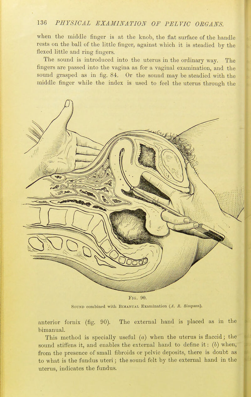 when the middle finger is at the knob, the flat surface of the handle rests on the ball of the little finger, against which it is steadied by the flexed little and ring fingers. The sound is introduced into the uterus in the ordinary way. The fingers are passed into the vagina as for a vaginal examination, and the sound grasped as in fig. 84. Or the sound may be steadied with the middle finger while the index is used to feel the uterus through the Fig. 90. Sound combined with Bimanual Examination {A. R. Simpson). anterior fornix (fig. 90). The external hand is placed as in the bimanual. This method is specially useful (a) when the uterus is flaccid; the sound stifi^ens it, and enables the external hand to define it: (b) when, from the presence of small fibroids or pelvic deposits, there is doubt as to what is the fundus uteri; the sound felt by the external hand in the uterus, indicates the fundus.