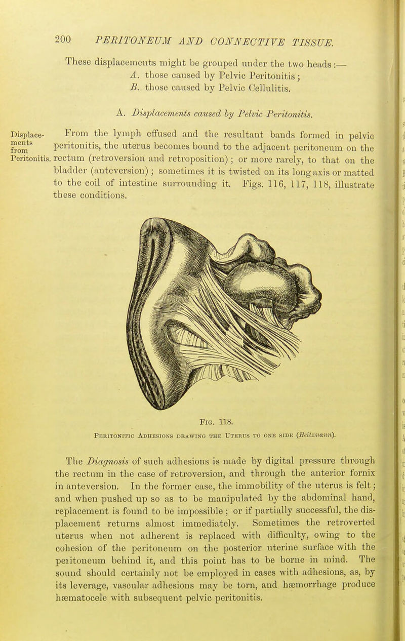 These displacements might be grouped under the two heads:— A. those caused by Pelvic Peritonitis; B. those caused by Pelvic Cellulitis. A. Displacements caused hy Pelvic Peritonitis. Displace- From the lymph eiTused and the resultant bands formed in pelvic ments peritonitis, the uterus becomes bound to the adjacent peritoneum on the reritonitis. rectum (retrovei'siou and retroposition); or more rarely, to that on the bladder (anteversion); sometimes it is twisted on its long axis or matted to the coil of intestine surrounding it. Figs. 116, 117, 118, illustrate these conditions. The Diagnosis of such adhesions is made by digital pressure through the rectum in the case of retroversion, and through the anterior fornix in anteversion. In the former case, the immobility of the uterus is felt; and when pushed up so as to be manipulated by the abdominal hand, replacement is found to be impossible ; or if partially successful, the dis- placement returns almost immediately. Sometimes the retroverted uterus when not adherent is replaced with diificulty, owing to the cohesion of the peritoneum on the posterior uterine surface with the peiitoneum behind it, and this point has to be borne in mind. The sound should certainly not be employed in cases with adhesions, as, by its leverage, vascular adhesions may be torn, and hemorrhage produce hsematocele with subsequent pelvic peritonitis.