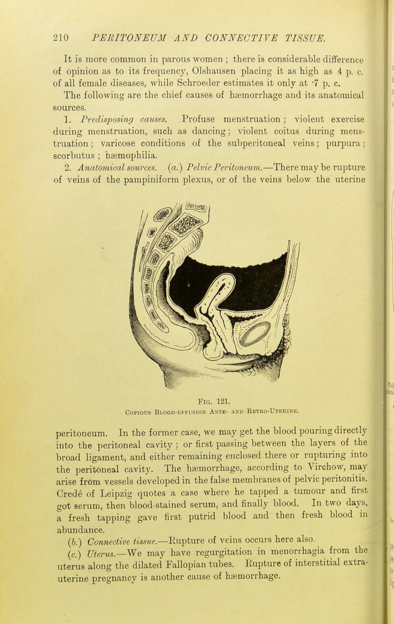 It is more common in parous women; there is considerable difference of opinion as to its frequency, Olshausen placing it as high as 4 p. c. of all female diseases, while Schroeder estimates it only at •! p. c. The following are the chief causes of haemorrhage and its anatomical sources. 1. Predisposing/ causes. Profuse menstruation; violent exercise during menstruation, such as dancing; violent coitus during mens- truation ; varicose conditions of the subperitoneal veins; purpura; scorbutus ; haemophilia. 2. Anatomical sources, (a.) Pelvic Peritoneum.—There may be rupture of veins of the pampiniform plexus, or of the veins below the uterine Fig. 121. Copious Blood-effusion Astb- and Eetro-Uterine. peritoneum. In the former case, we may get the blood pouring directly into the peritoneal cavity : or first passing between the layers of the broad ligament, and either remaining enclosed there or rupturing into the peritoneal cavity. The hajmorrhage, according to Virchow, may arise from vessels developed in the false membranes of pelvic peritonitis. Cred6 of Leipzig quotes a case where he tapped a tumour and first got serum, then blood-stained serum, and finally blood. In two days,  j a fresh tapping gave first putrid blood and then fresh blood in abundance. (6.) Connective <mwe.—Eupture of veins occurs here also. (c.) Uterus.—We may have regurgitation in menorrhagia from the uterus along the dilated Fallopian tubes. Rupture of interstitial extra- uterine pregnancy is another cause of hemorrhage.