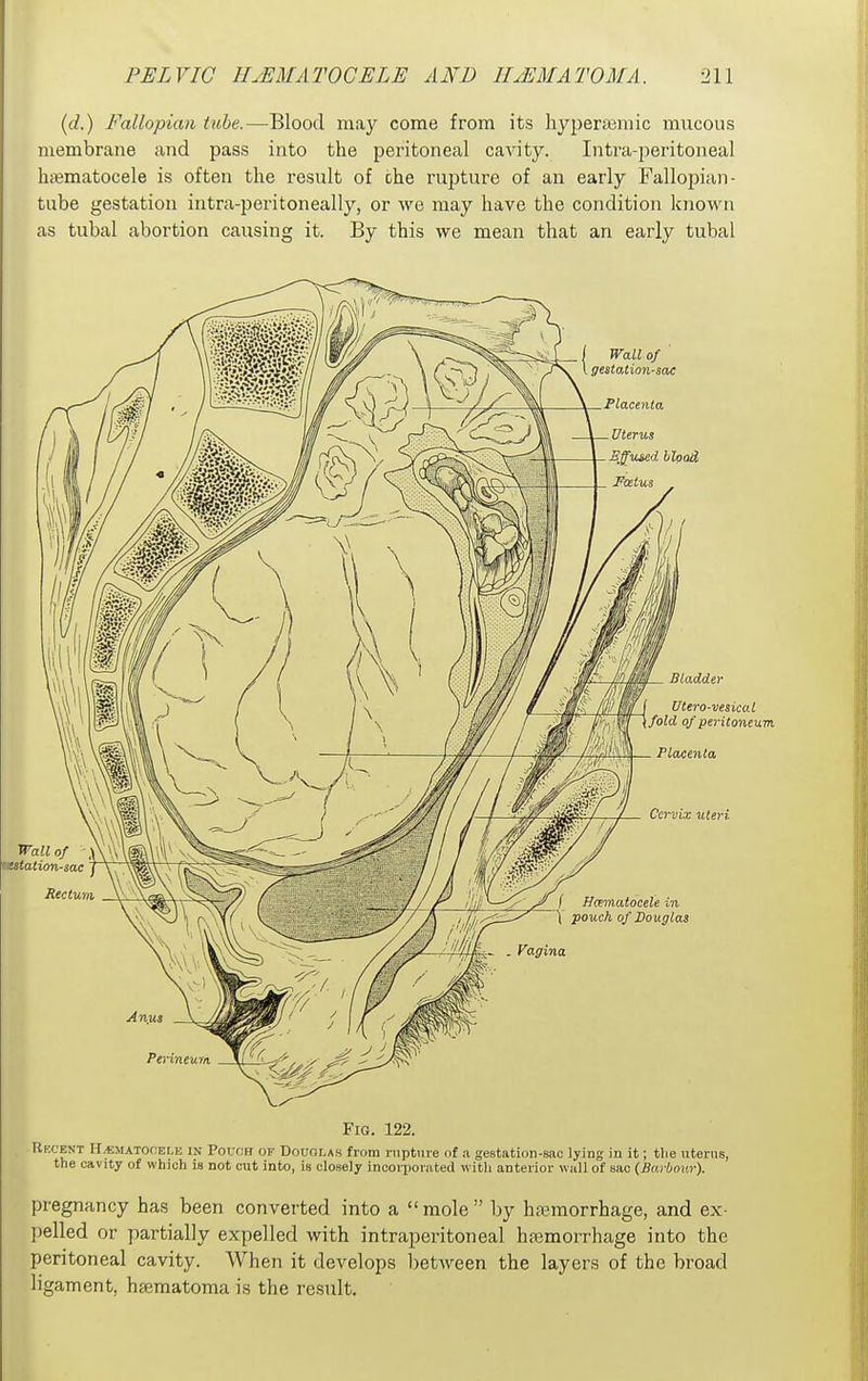 {d.) Fallopian tube.—Blood may come from its liyperiBmic mucous membrane and pass into the peritoneal cavity. Intra-peritoneal hiBmatocele is often the result of the rupture of an early Fallopian- tube gestation intra-peritoneally, or we may have the condition known as tubal abortion causing it. By this we mean that an early tubal Fig. 122. Recent H/ematocele in Pouch of Douoi.as from rupture of a gestation-sac lying in it; tlie uterus, the cavity of which is not cut into, is closely incorporated witli anterior wall of sac (Barbour). pregnancy has been converted into a  mole  by hemorrhage, and ex- pelled or ])artial]y expelled with intraperitoneal hajmorrhage into the peritoneal cavity. When it develops l)etween the layers of the broad ligament, hseraatoma is the result.