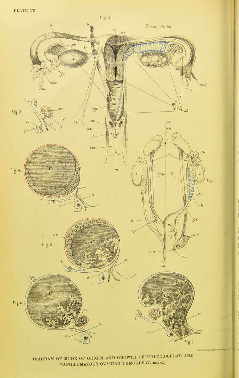 DIAGBAM OF MODE OF ORIGIN AND GROWTH OF MULTILOCULAR PAPILLOMATOUS OVARIAN TUMOURS (Coblenz).