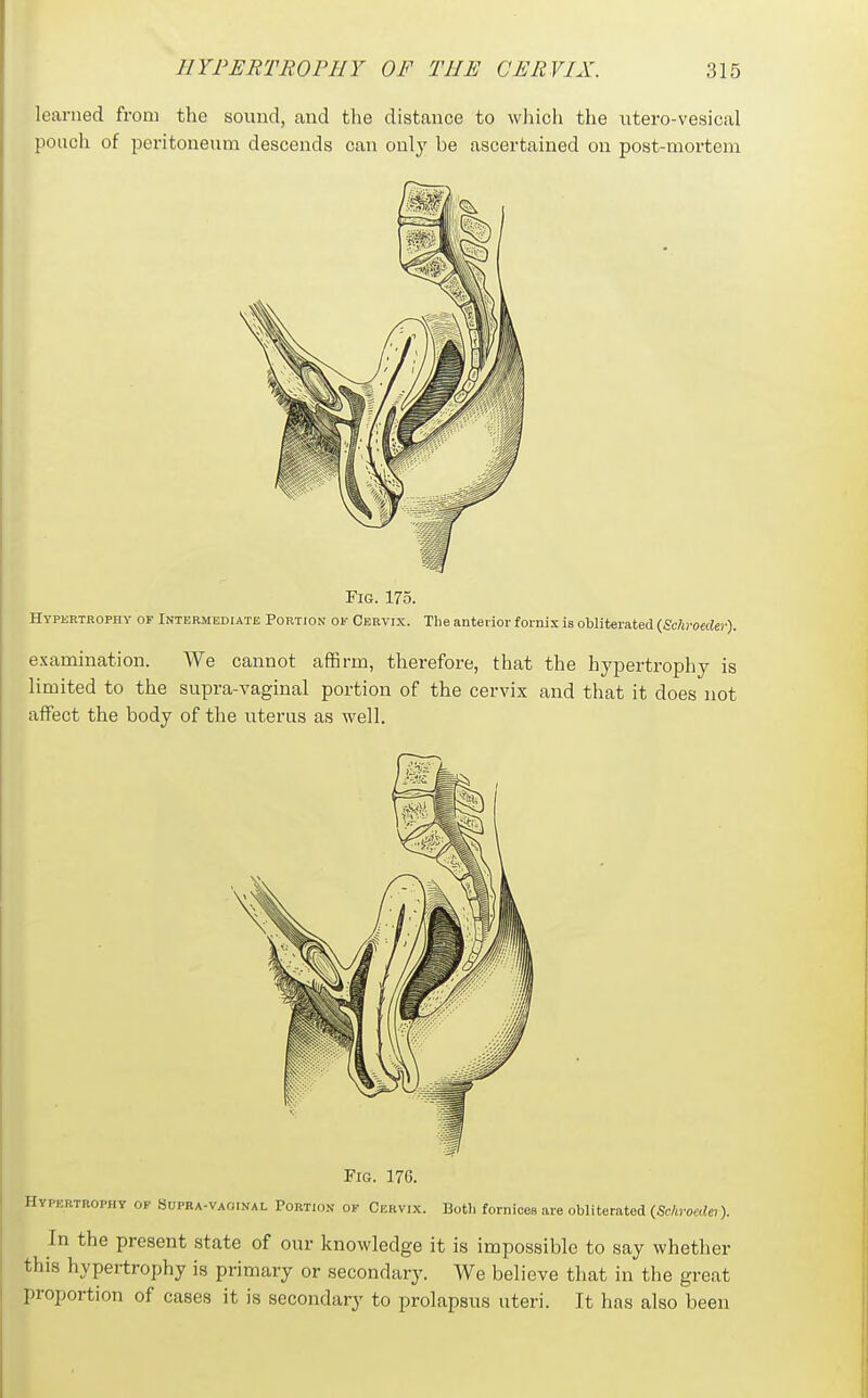 learned from the sound, and the distance to which the utero-vesical pouch of peritoneum descends can only be ascertained on post-mortem Fig. 175. Hypkrtrophy of Intermediate Portion of Cervix. The anterior fornix is obliterated {Schroeder). examination. AVe cannot affirm, therefore, that the hypertrophy is limited to the supra-vaginal portion of the cervix and that it does not affect the body of the uterus as well. Fig. 176. Hypertrophy of Sdpra-vaoinal Portio.n of Ckrvix. Botli fornices are obliterated (Schroeder). In the present state of our knowledge it is impossible to say whether this hypei-trophy is primary or secondary. We believe that in the great proportion of cases it is secondary to prolapsus uteri. It has also been