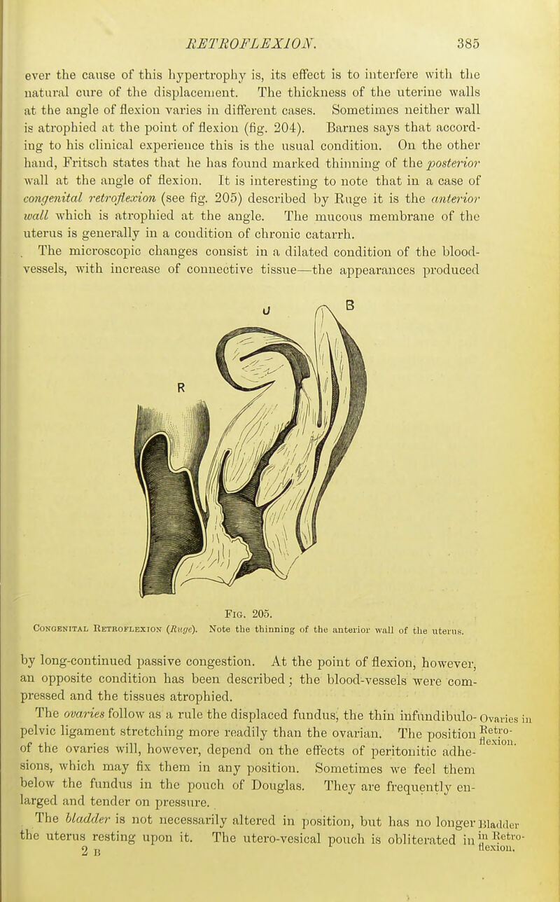 ever the cause of this hypertrophy is, its effect is to interfere with tlie natural cure of tlie displacement. The thickness of the viterine walls at the angle of flexion varies in different cases. Sometimes neither wall is atrophied at the point of flexion (fig. 204). Barnes says that accord- ing to his clinical experience this is the usual condition. On the other hand, Fritsch states that lie has found marked thinning of the iMsterior Avail at the angle of flexion. It is interesting to note that in a case of congenital retroflexion (see fig. 205) described by Ruge it is the anterior ivall which is atrophied at the angle. The mucous membrane of the uterus is generally in a condition of chronic catarrh. The microscopic changes consist in a dilated condition of the blood- vessels, with increase of connective tissue—the appearances produced Fig. 205. Congenital Retroflexion (Ruge). Note the thinning of the anterior wall of tlie uteins. by long-continued passive congestion. At the point of flexion, however, an opposite condition has been described; the blood-vessels were com- pressed and the tissues atrophied. The ovaries follow as a rule the displaced fundus, the thin infuudibulo- Ovaries i pelvic ligament stretching more readily than the ovarian. The position of the ovaries will, however, depend on the effects of peritouitic adhe- sions, which may fix them in any position. Sometimes we feel them below the fundus in the pouch of Douglas. They are frequently en- larged and tender on pressure. The bladder is not necessarily altered in position, but has no longer Jiiadder the uterus resting upon it. The utero-vesical pouch is obliterated ini^^*' 2 jj nexiou.