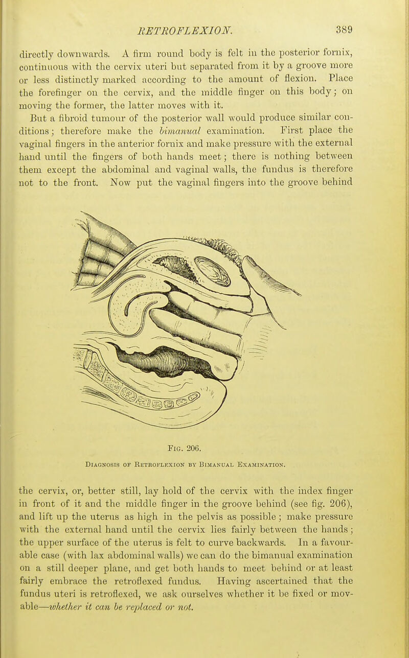 directly downwards. A firm round body is felt in the posterior fornix, continuous with the cervix uteri but separated from it by a groove more or less distinctly marked according to the amount of flexion. Place the forefinger on the cervix, and the middle finger on this body; on moving the foi'mer, the latter moves with it. But a fibroid tumour of the posterior wall would produce similar con- ditions ; therefore make the himanual examination. First place the vaginal fingers in the anterior fornix and make pressure with the external hand until the fingers of both hands meet; there is nothing between them except the abdominal and vaginal walls, the fundus is thei-efore not to the front. Now put the vaginal fingers into the groove behind Fig. 206. Diagnosis of RETRorLKXioN by Bimanual Examination. the cervix, or, better still, lay hold of the cervix with the index finger in front of it and the middle finger in the groove behind (see fig. 206), and lift up the utenis as high in the pelvis as possible; make pressure with the external hand until the cervix lies fairly between the hands; the upper surface of the uterus is felt to curve backwards. In a favour- able case (with lax abdominal walls) we can do the bimanual examination on a still deeper plane, and get both hands to meet behind or at least fairly embrace the rctroflexed fundus. Having ascertained that the fundus uteri is retroflexed, we ask ourselves whether it be fixed or mov- able—wkellier it can he rej^laced or not.