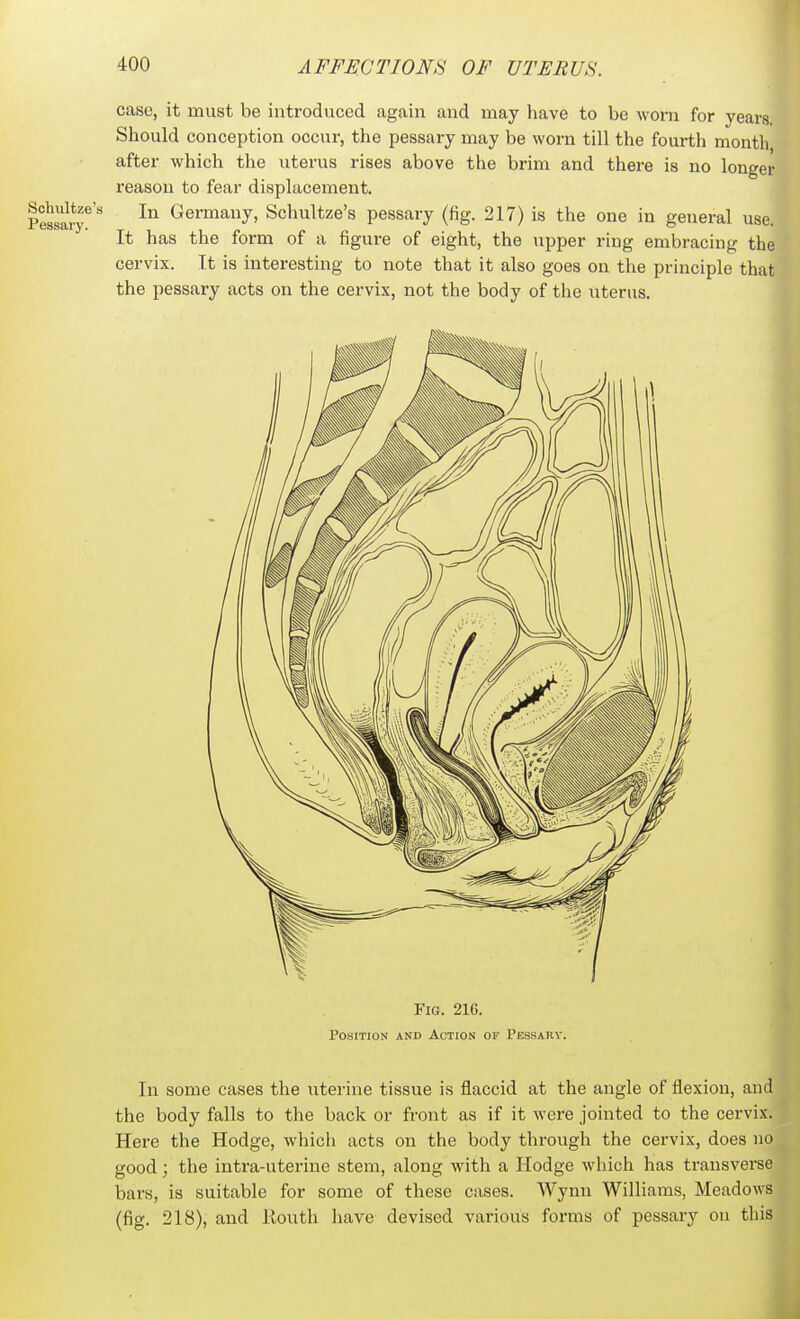 case, it must be introduced cigaiii and may have to be worn for years Should conception occur, the pessary may be worn till the fourth month after which the uterus rises above the brim and there is no longer reason to fear displacement. Pessai*^^''' Germany, Schultze's pessary (fig. 217) is the one in general use. It has the form of a figure of eight, the upper ring embracing the cervix. It is interesting to note that it also goes on the principle that the pessary acts on the cervix, not the body of the uterus. Fig. 216. Position and Action of Pessary. In some cases the uterine tissue is flaccid at the angle of flexion, and the body falls to the back or front as if it were jointed to the cervix. Here the Hodge, whicli acts on the body through the cervix, does no good; the intra-uterine stem, along with a Hodge which has transverse bars, is suitable for some of these cases. Wynn Williams, Meadows (fig. 218), and Routh have devised various forms of pessary on this