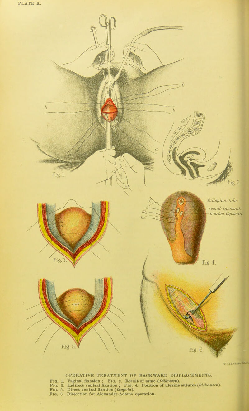 OPBKATIVE TREATMENT OF BACKWARD DISPLACEMENTS. Fro. 1. Vaginal fixation ; Fig. 2. Result o{ same (X>uAmi»v). Fig. 8. Indirect ventral fixation ; Fio. 4. Puaition of uterine sutures (OUhausen). FiO. 5. Direct ventral fixation [Leopold). Fio. 6. Dissection for Alexander-Adams operation.