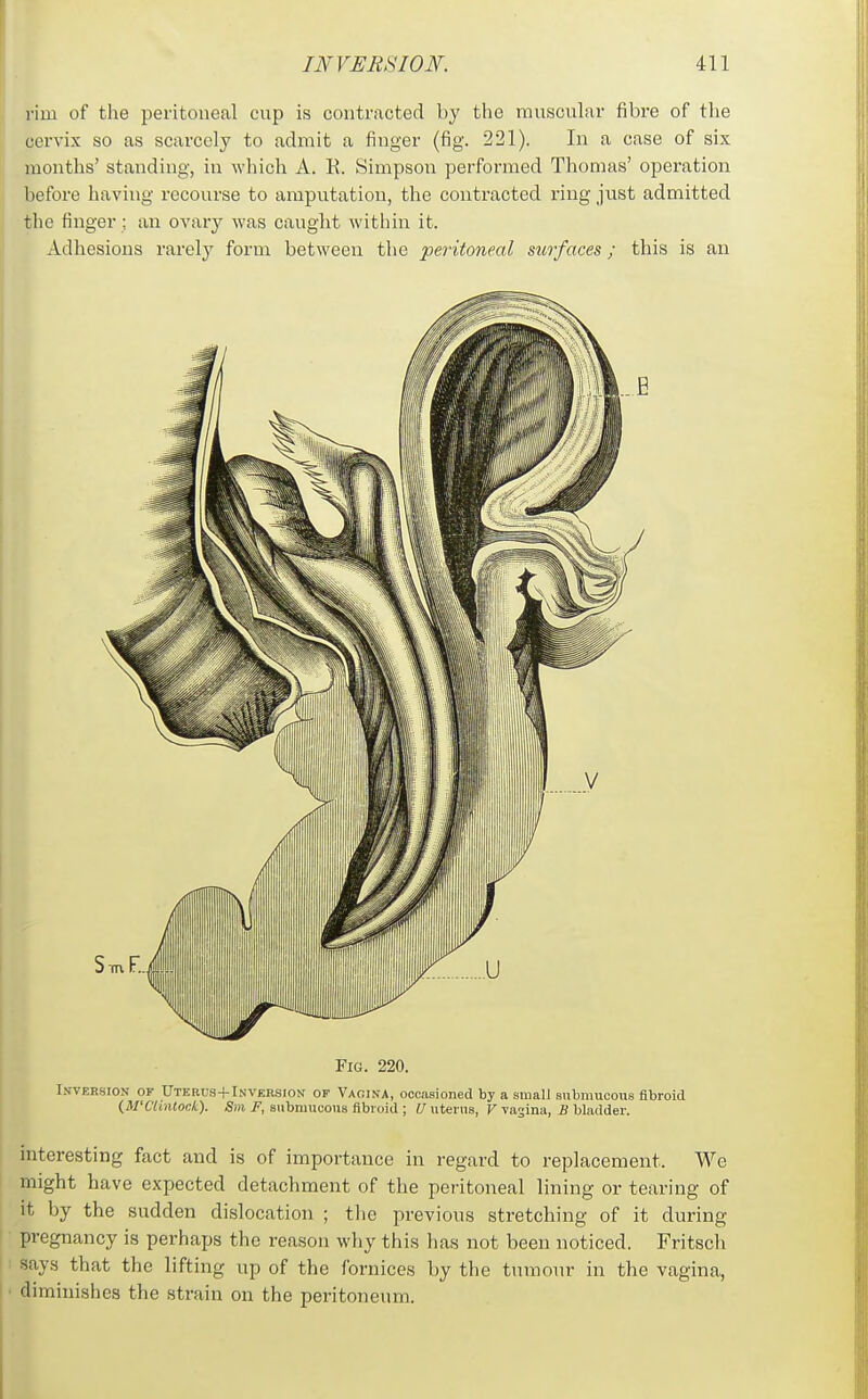 rim of the peritoneal cup is contracted by the muscular fibre of the cervix so as scarcely to admit a finger (fig. 221). In a case of six mouths' standing, in which A. E. Simpson performed Thomas' operation before having recourse to amputation, the contracted x'ing just admitted the finger; an ovary was caught within it. Adhesions rarely form between the peritoneal surfaces; this is an Fig. 220. In-veksion of Uterus+Inversion of Vagina, occasioned by a small submucous fibroid (M'Clintock). S»i ii, submucous fibroid ; i/uterus, F vajina, i! bladder. interesting fact and is of importance in regard to replacement. We might have expected detachment of the peritoneal lining or tearing of it by the sudden dislocation ; the previous stretching of it during pregnancy is perhaps the reason why this has not been noticed. Fritsch says that the lifting up of the fornices by the tumour in the vagina, diminishes the strain on the peritoneum.