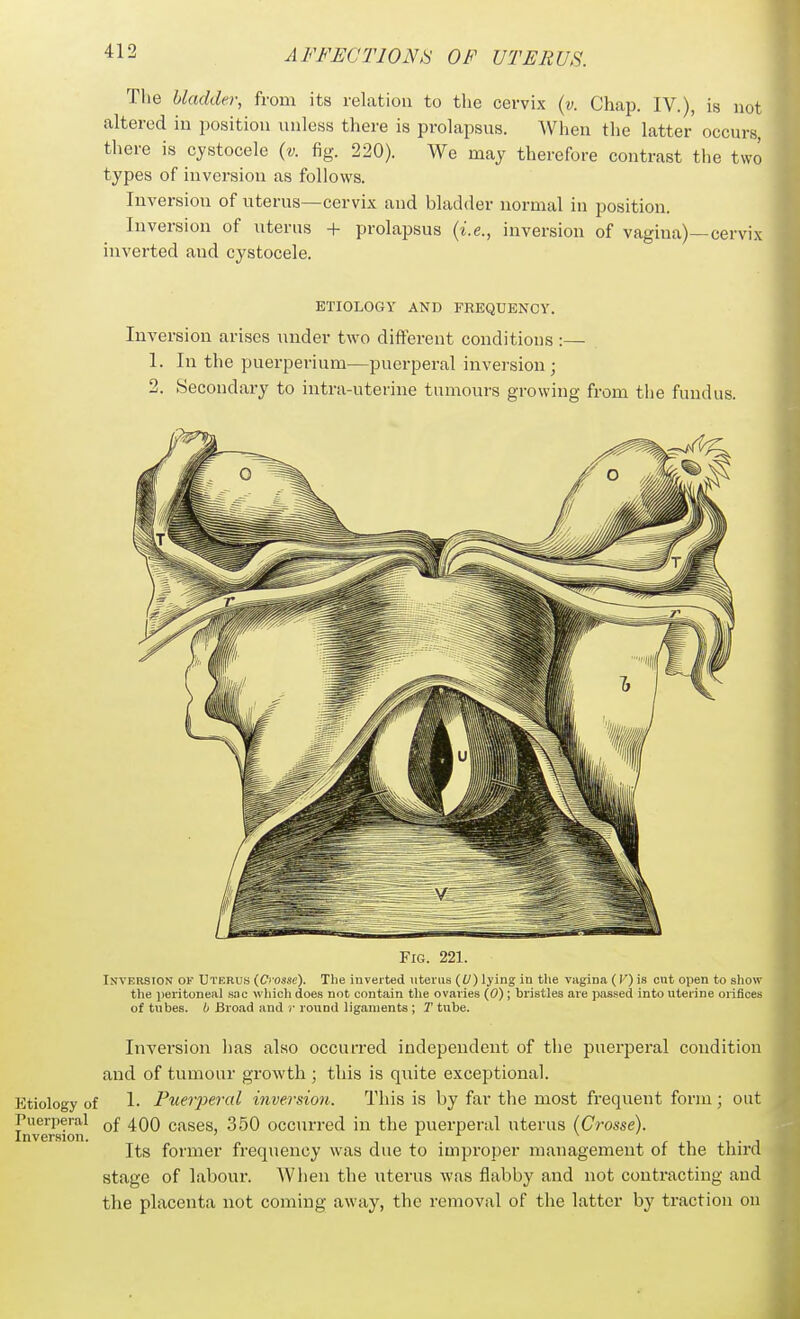 Tlie bladder, from its relation to the cervix {v. Chap. IV.), is not altered in position unless there is prolapsus. When the latter' occurs, there is cystocele {v. fig. 220). We may therefore contrast the two types of inversion as follows. Inversion of uterus—cervix and bladder normal in position. Inversion of uterus + prolapsus {i.e., inversion of vagina)—cervix inverted and cystocele. ETIOLOGY AND FREQUENCY. Inversion arises under two different conditions :— 1. In the puerperium—puerperal inversion; 2. Secondary to intra-uterine tumours growing from the fundus. Fig. 221. Inversion of Uterus {Crosse). The inverted uteriiB (i/) lying in the vagina (V) is cut open to show the peritoneal sac which does not contain the ovaries (0); bristles are passed into uterine orifices of tubes, b Broad and )■ round ligaments ; T tube. Inversion has also occurred independent of the puerperal condition and of tumour growth ; this is qiiite exceptional. Etiology of 1- Puerperal inversion. This is by far the most frequent form; out Puerperal Qf 4QQ cases, 350 occurred in the puerperal uterus (Crosse). Inversion. ^ r i 1 • j Its former frequency was due to improper management or the third stage of labour. When the uterus was flabby and not contracting and the placenta not coming away, the removal of the latter by traction on