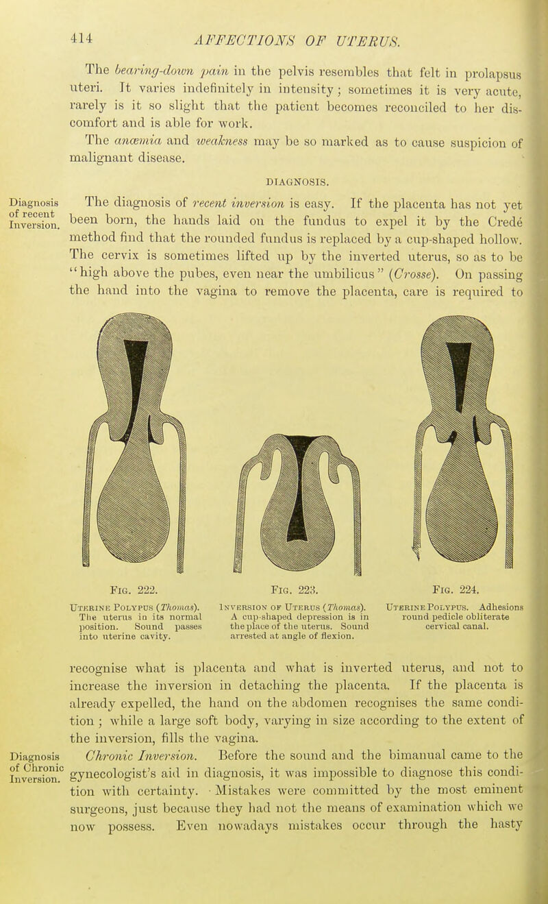 The bearing-doiu7i pain in the pelvis resembles that felt in prolapsus uteri. It varies indefinitely in intensity ; sometimes it is very acute, rarely is it so slight that the patient becomes reconciled to her dis- comfort and is able for work. The ancBviia and loeakness may be so marked as to cause suspicion of malignant disease, DIAGNOSIS. Diagnosis The diagnosis of recent inversion is easy. If the placenta has not yet Inversion. ^^^^ born, the hands laid on the fundus to expel it by the Crede method find that the rounded fundus is replaced by a cup-shaped hollow. The cervix is sometimes lifted up by the inverted uterus, so as to be high above the pubes, even near the umbilicus (Crosse). On passing the hand into the vagina to remove the placenta, care is required to Fig. 222. Fig. 223. Fig. 224. XJtkrine Polypus (Thomas). 1n\'ersion of Utekvs {Thomas). Urbrine Polypus. Adhesions The uterus in its normal A cup-shaped depression is in round pedicle obliterate position. Sound passes the place of the utenis. Sound cervical canal, into uterine cavity. arrested at angle of flexion. recognise what is placenta and what is inverted uterus, and not to increase the inversion in detaching the placenta. If the placenta is already expelled, the hand on the abdomen recognises the same condi- tion ; while a large soft body, varying in size according to the extent of the inversion, fills the vagina. Chronic Inversion. Before the sound and the bimanual came to the gynecologist's aiil in diagnosis, it was impossible to diagnose this condi- tion with certainty. ■ Mistakes were committed by the most eminent surgeons, just because they had not the means of examination which we now possess. Even nowadays mistakes occur through the hasty