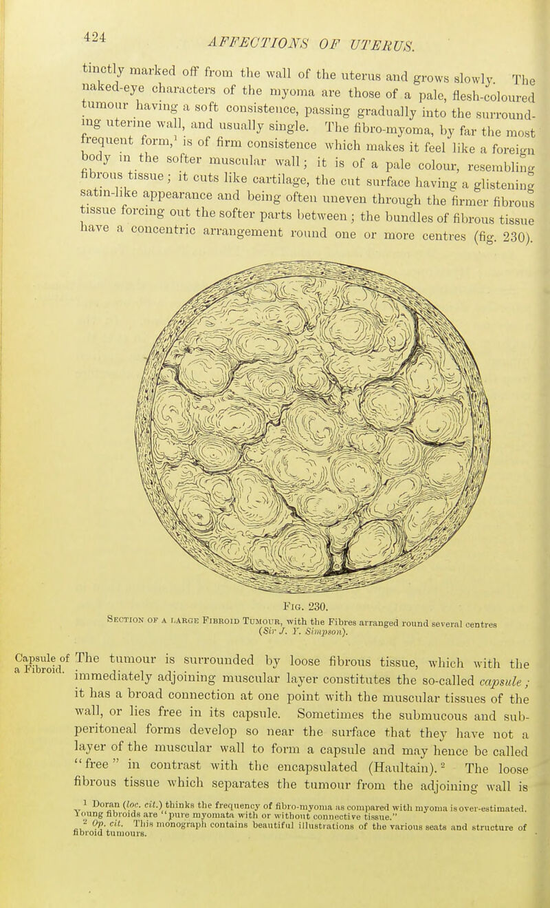 tinctly marked off from tl.e wall of the uterus a,id grows slowly The naked-eye characters of the myoma are those of a pale, flesh-coloured tumour havmg a soft consisteuce, passiug gradually into the surround- ing utenne wa 1, and usually single. The fibro-myoma, by far the most irequeut form, is of firm consistence which makes it feel like a foreign body m the softer muscular wall; it is of a pale colour, resen.bling fibrous tissue; it cuts like cartilage, the cut surface having a glistening satm-hke appearance and being often uneven through the firmer fibrous tissue forcing out the softer parts between ; the bundles of fibrous tissue nave a concentric arrangement round one or more centres (fio- 230) Fig. 230. Section of a r.AROE Fibroid Tumour, with the Fibres arranged round several centres (Sir J. Y. Simpson). ?Fibrdd°^ .^^^ tumour is surrounded by loose fibrous tissue, which with the immediately adjoining muscular layer constitutes the so-called ccqmde ; it has a broad connection at one point with the muscular tissues of the wall, or lies free in its capsule. Sometimes the submucous and sub- peritoneal forms develop so near the surface that they have not a layer of the muscular wall to form a capsule and may hence be called free in contrast with the encapsulated (Haultain). - The loose fibrous tissue which separates the tumour from the adjoining wall is 1 Doran (loc. cii.) thinks the frequency of fibro-niyonia as compared witli myoma is over-estimated, loung fibroids are pure rayomata witli or without connective tissue. cu ^J'-J^'' ''■''i'* monograph contains beautiful illustrations of the various seats and structure of nbroid tumours. Jk