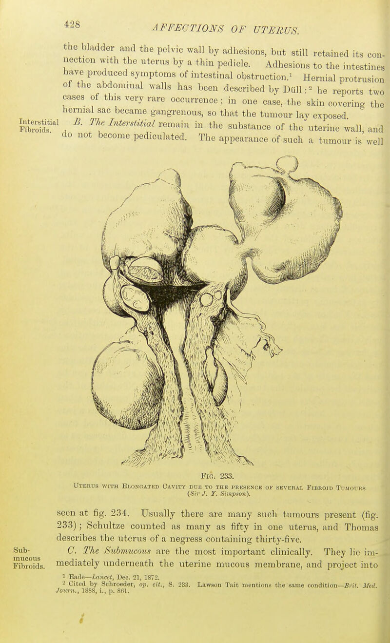 the bladder and the pelvic wall by adhesions, but still retained its con- nection with the uterus by a thin pedicle. Adhesions to the intestines have produced symptoms of intestinal obstruction.^ Hernial protrusion of the abdominal M-alls has been described by Dull:^ he reports two cases of this very rare occurrence : in one case, the skin covering the hernial sac became gangrenous, so that the tumour lay exposed S£oS' , 5'!' ^^'-''^i^^ ^-^^ai in the substance of the uterine wall, and do not become pediculated. The appearance of such a tumour is well Sub- mucous Fibroids. Fio. 233. Uterus with Elongated Cavjtv due to the presence of several Fibrojd Tumours {Sir J. Y. Simpson). seen at fig. 234. Usually there are many such tumours present (fig. 233); Schultze counted as many as fifty in one uterus, and Thomas describes the uterus of a negress containing thirty-five. C. The Submucous are the most important clinically. They lie im- mediately imderneath the uterine mucous membrane, and project into 1 Eadc—/.(Micei, Dec. 21, 18T2. - Cited by Scliroeder, op. cit., S. 233. L.iwson Tiiit mentions tlie s.ame condition—Biit. Med. Journ., ISSS, i., p. S61. I