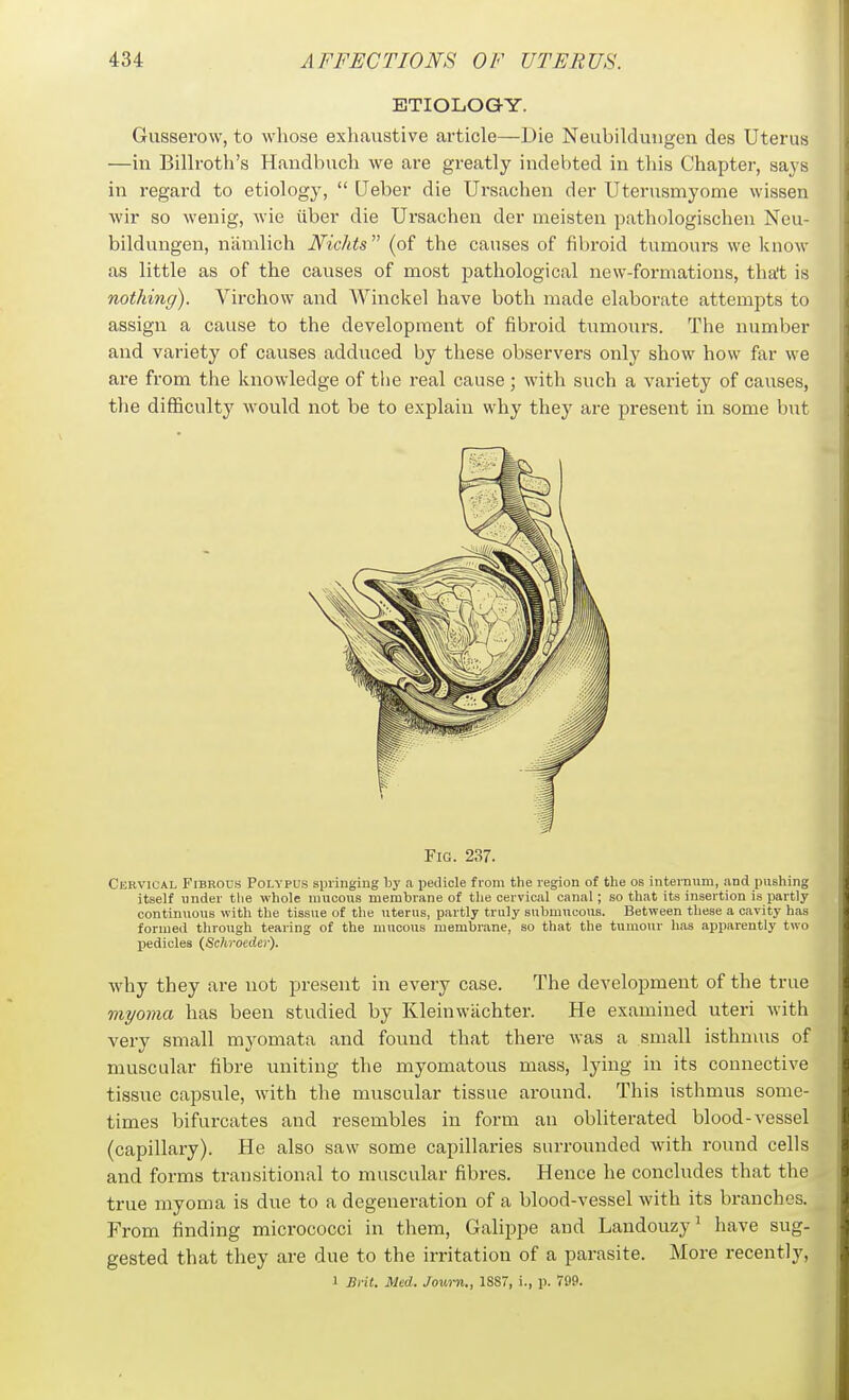 ETIOLOGY. Gusserow, to whose exhaiistive article—Die Neubilduiigcn des Uterus —in Billroth's Handbucli we are greatly indebted in this Chapter, says in regard to etiology,  Qeber die Ursachen der Uterusmyome wissen wir so wenig, wie iiber die Ursachen der meisten pathologischen Neu- bildungen, nlimlich Nichts  (of the causes of fibroid tumours we know as little as of the causes of most pathological new-formations, tha't is nothing). Virchow and Winckel have both made elaborate attempts to assign a cause to the development of fibroid tumours. The number and variety of causes adduced by these observers only show how far we are from the knowledge of the real cause ; with such a variety of causes, the difiBculty would not be to explain why they are present in some but Fig. 237. Cervical Fibrous Polypus springing by a pedicle from the region of the os internum, and pushing itself under tlie whole mucous membrane of the cervical canal; so that its insertion is partly continuous with the tissue of the uterus, partly truly submucous. Between these a cavity has formed through tearing of the mucous membrane, so that the tumour has apparently two Ijedicles (Schroeder). why they are not present in every case. The development of the true myoma has been studied by Klein wiichter. He examined uteri with very small myomata and found that there was a small isthnuis of muscular fibre uniting the myomatous mass, Ij'ing in its connective tissue capsule, with the muscular tissue around. This isthmus some- times bifurcates and resembles in form an obliterated blood-vessel (capillary). He also saw some capillaries surrounded with round cells and forms transitional to muscular fibres. Hence he concludes that the true myoma is due to a degeneration of a blood-vessel with its branches. From finding micrococci in them, Galippe and Landouzy' have sug- gested that they are due to the irritation of a parasite. More recently, 1 Brit. Med. Journ., 18S7, i., p. 799.