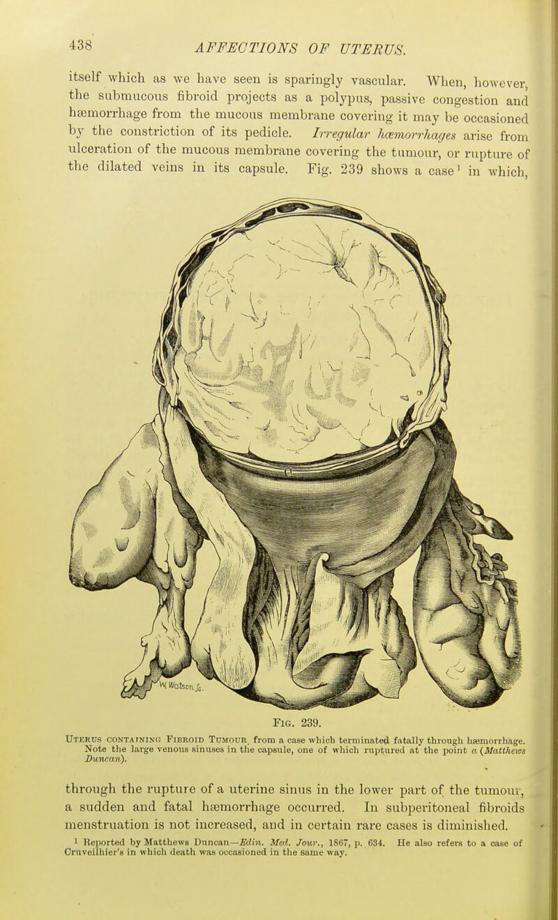 itself which as we have seen is sparingly vascular. When, however, the submucous fibroid projects as a polypus, passive congestion and ha3morrhage from the mucous membrane covering it may be occasioned by the constriction of its pedicle. Irregular hcemorrhages arise from ulceration of the mucous membrane covering the tumour, or rupture of the dilated veins in its capsule. Fig. 239 shows a case' in which. Fig. 239. Uterus containing Fibroid TniiouR. from a case which terminated fatally through haemorrhage. Note the large venous sinuses in the capsule, one of which ruptured at the point a {Matthews Duncan). through the rupture of a uterine sinus in the lower part of the tumour, a sudden and fatal hfemorrhage occurred. In subperitoneal fibroids menstruation is not increased, and in certain rare cases is diminished. 1 Reported by Matthews Duncan—iWiji. Med. Jour., 1867, p. 634. He also refers to a case of Cruveiihier's in whicli death was occasioned in the same way.