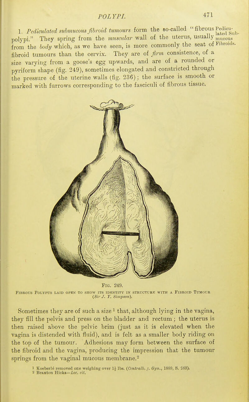 1. Pediculated siihimicous fibroid tumours form the so-called  ^^^^o^^ J^^^^jf^^b. polypi. They spring from the muscular -wall of the uterus, usually ynwcow from the body which, as we have seen, is more commonly the seat of Fibroids, fibroid tumours than the cervix. They are of fi.rm consistence, of a size varying from a goose's egg upwards, and are of a rounded or pyriform shape (fig. 249), sometimes elongated and constricted through the pressure of the uterine walls (fig. 236); the surface is smooth or marked with furrows corresponding to the fasciculi of fibrous tissue. Sometimes they are of such a size ^ that, although lying in the vagina, they fill the pelvis and press on the bladder and rectum; the uterus is then raised above the pelvic brim (just as it is elevated when the vagina is distended with fluid), and is felt as a smaller body riding on the top of the tumour. Adhesions may form between the surface of the fibroid and the vagina, producing the impression that the tumour springs from the vaginal mucous membrane.'^ 1 Koeberli removed one weighing over IJ lbs. {Ccnlralb. j. Gyn., 1889, S. 268). 2 Braxton Uiokg—ioc. cit.