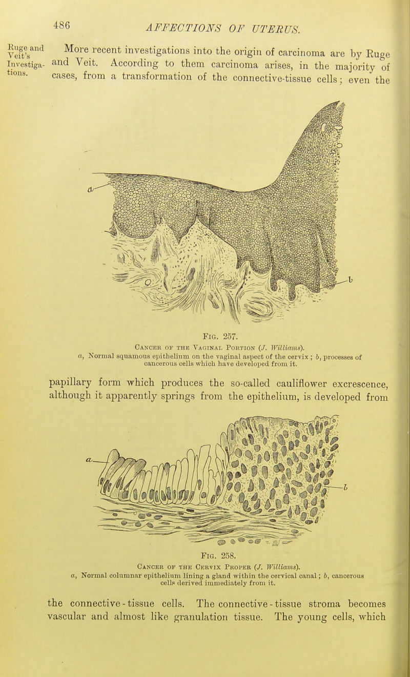Ruge^aud More recent investigations into the origin of carcinoma arc by Euge Investiga- ^nd Veit. According to them carcinoma arises, in the majority of cases, from a transformation of the connective-tissue cells; even the Fig. 257. Cancer ok the Vaginal Portion (/. WUliamx). a, Norma] squamous epithelium ou the vaginal aspect of the cervix ; b, processes of cancerous cells which have developed from it. papillary form which produces the so-called cauliflower excrescence, although it apparently springs from the epithelium, is developed from Fig. 258. Cancer of tub Cervix Proper Williams), a, Normal columnar epithelium lining a gland within the cervical canal; b, cancerous cells derived immediately from it. the connective - tissue cells. The connective - tissue stroma becomes vascular and almost like granulation tissue. The young cells, which