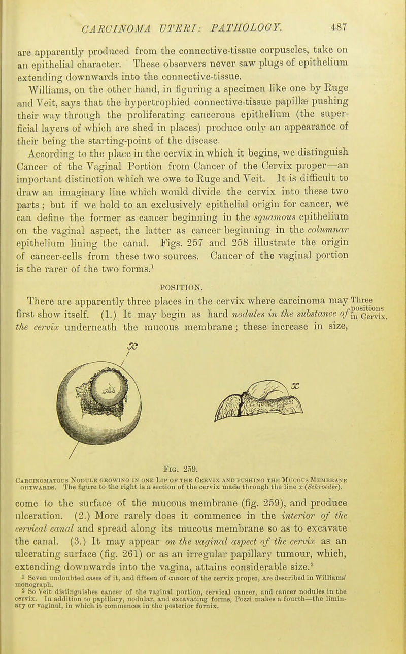 are apparently produced from the connective-tissue corpuscles, take on an epithelial character. These observers never saw plugs of epithelium extending downwards into the connective-tissue. Williams, on the other hand, in iigui'ing a specimen like one by Ruge and Veit, says that the hypertrophied connective-tissue papillie pushing their way through the proliferating cancerous epithelium (the super- ficial layers of which are shed in places) produce only an appearance of their being the starting-point of the disease. According to the place in the cervix in which it begins, we distinguish Cancer of the Vaginal Portion from Cancer of the Cervix proper—an important distinction which we owe to Ruge and Veit. It is difficult to draw an imaginary line which would divide the cervix into these two parts; but if we hold to an exclusively epithelial origin for cancer, we can define the former as cancer beginning in the squamous epithelium on the vaginal aspect, the latter as cancer beginning in the columnar epithelium lining the canal. Figs. 257 and 258 illustrate the origin of cancer-cells from these two sources. Cancer of the vaginal portion is the rarer of the two forms.^ POSITION. There are apparently three places in the cervix where carcinoma may Three first show itself. (1.) It may begin as hard nodules in the substance o/f^ Qg\?yi' the cervix underneath the mucous membrane; these increase in size, SO / Fig. 259. Cabcinomatods Nodule gbowino in one Ltp of the Cervix andpdshing the Mucous Membrane OUTWARDS. The figure to the right is a section of the cervix made through the line x {Schroeder). come to the surface of the mucous membrane (fig. 259), and produce ulceration. (2.) More rarely does it commence in the interior of the cervical canal and spread along its mucous membrane so as to excavate the canal. (3.) It may appear on the vaginal aspect of the cervix as an ulcerating surface (fig. 261) or as an irregular papillary tumour, which, extending downwards into the vagina, attains considerable size. 1 Seven undoubted cases of it, and fifteen of cancer of tlie cervix proper, are described in Williams' monograph. 2 So Veit distinguishes cancer of the vaginal portion, cervical cancer, and cancer nodules in the cervix. In addition to papillary, nodular, and excavating forms, Pozzi makes a fourth—the limin- ary or vaginal, in which it commences in the posterior fornix.