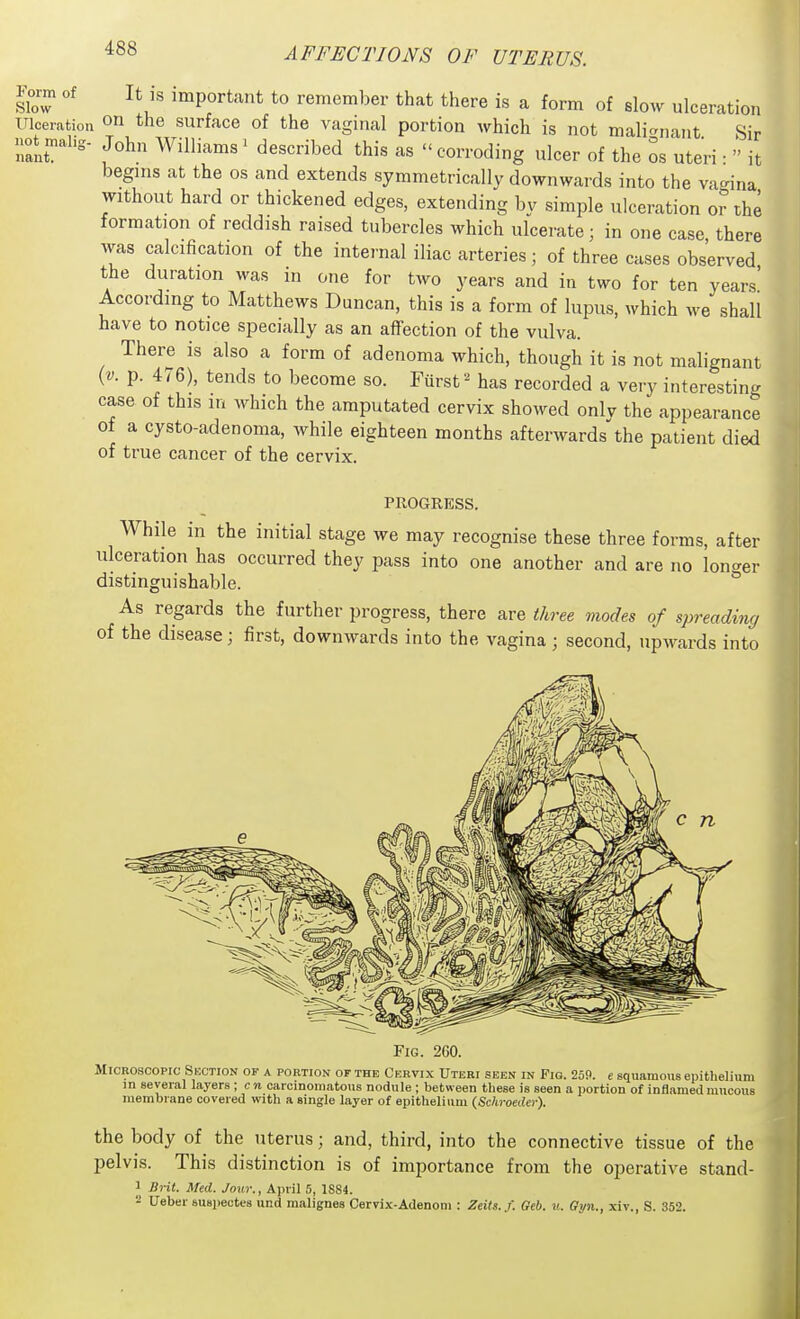 Jom of It ,s important to remember that there is a form of slow ulceration Ulceration On the surface of the vaginal portion which is not mali<rnant Sir not^malig. John Williams' described this as  corroding ulcer of the os uteri ■  it begins at the os and extends symmetrically downwards into the va<^ina without hard or thickened edges, extending by simple ulceration o?the formation of reddish raised tubercles which ulcerate; in one case there was calcification of the internal iliac arteries; of three cases observed the duration was in one for two years and in two for ten years' According to Matthews Duncan, this is a form of lupus, which we shall have to notice specially as an affection of the vulva. There is also a form of adenoma which, though it is not malignant {v. p. 476), tends to become so. Fiirst^ has recorded a very interesting case of this in which the amputated cervix showed onlv the appearance of a cysto-adenoma, while eighteen months afterwards'the patient died of true cancer of the cervix. PROGRESS. While in the initial stage we may recognise these three forms, after ulceration has occurred they pass into one another and are no longer distinguishable. ^ As regards the further progress, there are three modes of spreading of the disease; first, downwards into the vagina; second, upwards into I Fig. 260. Microscopic Section of a portion of the Cervix Uteri seen in Fio. 259. e squamous epithelium in several layers ; c n carcinomatous nodule ; between these is seen a portion of inflamed mucous membrane covered with a single layer of epithelium (Scliroeder). the body of the uterus; and, third, into the connective tissue of the pelvis. This distinction is of importance from the operative stand- 1 Ji-i-it. Med. Jour., Ajiril 5, 1SS4. 2 Ueber suspectcs und malignes Cervix-Adenom : Zeits..f. Oeb. u. Gyn., xiv., S. 352.