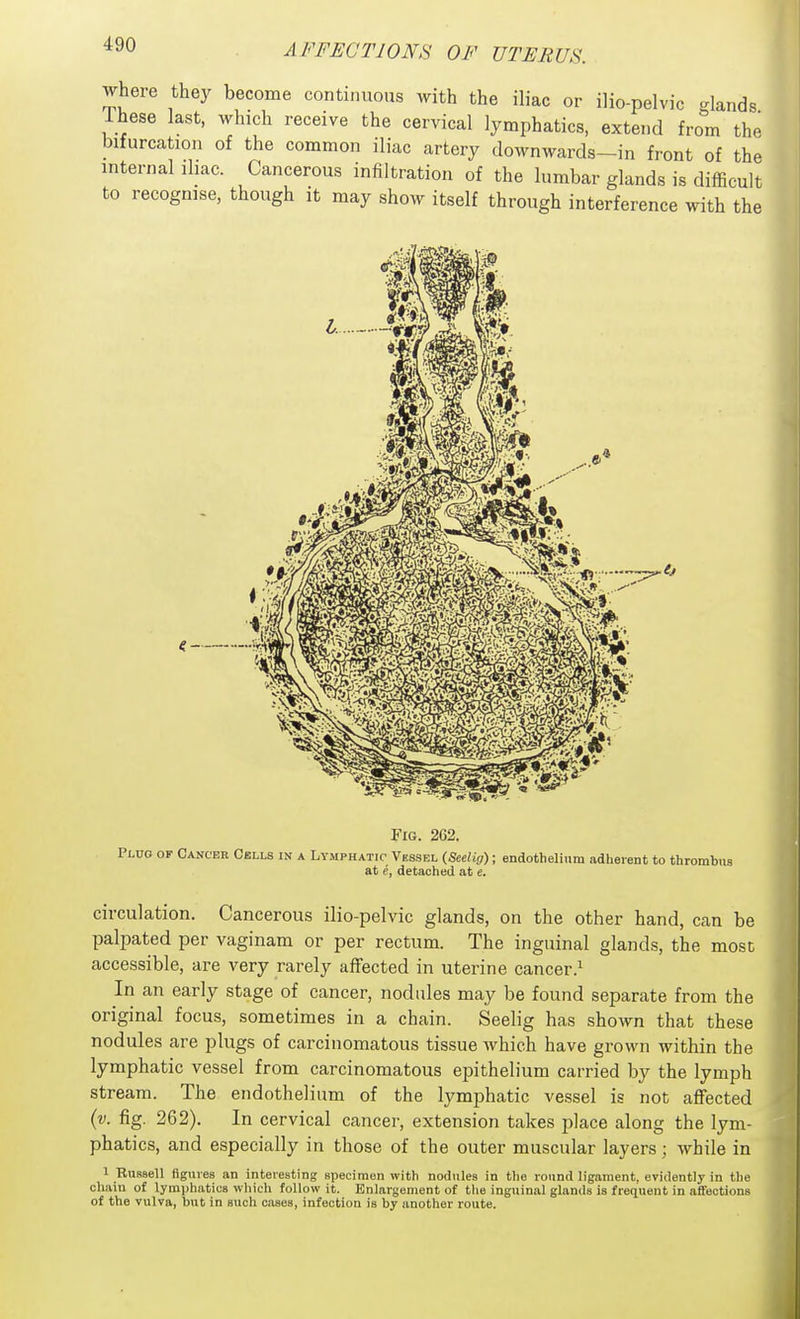 where they become continuous with the ihac or ilio-pelvic ..lands Ihese last, which receive the cervical lymphatics, extend from the bifurcation of the common iliac artery downwards—in front of the internal iliac. Cancerous infiltration of the lumbar glands is difficult to recognise, though it may show itself through interference with the Fig. 262. Pi,no OF Cancer Cells ik a Lymphatic Vessel (Seelig); endothelium adherent to thrombus at c, detached at e. circulation. Cancerous ilio-pelvic glands, on the other hand, can be palpated per vaginam or per rectum. The inguinal glands, the most accessible, are very rarely affected in uterine cancer.^ In an early stage of cancer, nodules may be found separate from the original focus, sometimes in a chain. Seelig has shown that these nodules are plugs of carcinomatous tissue which have grown within the lymphatic vessel from carcinomatous epithelium carried by the lymph stream. The endothelium of the lymphatic vessel is not affected {v. fig. 262). In cervical cancer, extension takes place along the lym- phatics, and especially in those of the outer muscular layers; while in 1 RusBell ftgnves an interesting specimen with nodules in tlie round ligament, evidently in the cliain of lymi)hatic8 which follow it. Enlargement of the inguinal glands is frequent in affections of the vulva, but in such oases, infection is by another route.