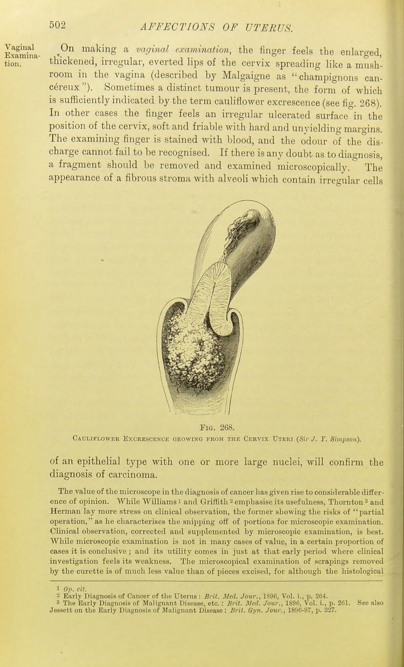 On making a vaginal examination, the finger feels the enlarged thickened, irregular, everted lips of the cervix spreading like a mush- room in the vagina (described by Malgaigne as champignons can- c6reux ). Sometimes a distinct tumour is present, the form of which is sufficiently indicated by the term cauliflower excrescence (see fig. 268). In other cases the finger feels an irregular ulcerated surface in the position of the cervix, soft and friable with hard and unyielding margins. The examining finger is stained with blood, and the odour of the dis- charge cannot fail to be recognised. If there is any doubt as to diagnosis, a fragment should be removed and examined microscopically. The appearance of a fibrous stroma with alveoli which contain irregular cells Fig. 268. Cauliflower Excrkscence growing from the Cervix Uteri (Sic J. Y. Simpson). of an epithelial type with one or more large nuclei, will confirm the diagnosis of carcinoma. The value of the microscope in the diagnosis of cancer lias given rise to considerable differ- ence of ojiinion. While Williams i and Griffith - emphasise its usefulness, Thornton ^ and Herman lay more stress on clinical observation, the former showing the risks of partial operation, as he characterises the snijiping off of portions for microscojiic examination. Clinical observation, corrected and supplemented by microscoiiic examination, is best. While microscopic examination is not in many cases of value, in a certain proportion of cases it is conclusive ; and its utility comes in just at that early period where clinical investigation feels its weakness. The microscopical examination of scrapings removed by the curette is of much less value than of pieces excised, for although the histological 1 Op. cil.  Early Diagnosis of Cancer of the Uterus : Brit. Med. Jour., ISflfi, Vol. i., p. 264. 3 The Early Diagnosis of Malignant Disease, etc. : Brit. Med. Jour., lS9f), Vol. i., p. 201. See also Jessett on the Early Diagnosis of Malignant Disease : Brit. Gyn. Jour., 18S)C-97, p. 32T.