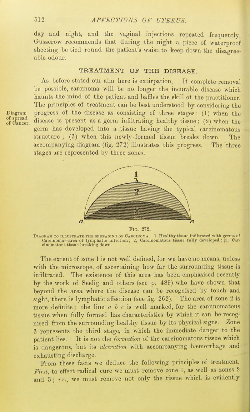 day and night, and the vaginal injections repeated frequently. Gusserow recommends that during the night a piece of waterproof sheeting be tied round the patient's waist to keep down the disagree- able odour. TREATMENT OF THE DISEASE. As before stated our aim here is extirpation. If complete removal be possible, carcinoma will be no longer the incurable disease which haunts the mind of the patient and baffles the skill of the practitioner. The principles of treatment can be best understood by considering the Diagram progress of the disease as consisting of three stages : (1) when the ofcfa^ncfr. disease is present as a germ infiltrating healthy tissue; (2) when the germ has developed into a tissue having the typical carcinomatous structure ; (3) when this newly-formed tissue breaks down. The accompanying diagram (fig. 272) illustrates this progress. The three stages are rejjresented by three zones. a Fig. 272. Diagram to illustrate the spreading of Carcinoma. 1, Healthy tissue iniUtrated with germs of Carcinoma—area of lymphatic infection ; 2, Carcinomatous tissue fully developed ; [3, Car- cinomatous tissue breaking down. The extent of zone 1 is not well defined, for we have no means, unless with the microscope, of ascertaining how far the surrounding tissue is infiltrated. The existence of this area has been emphasised recently by the work of Seelig and others (see p. 489) who have shown that beyond the area where the disease can be recognised by touch and sight, there is lymphatic affection (see fig. 262). The area of zone 2 is more definite; the line a 6 c is well marked, for the carcinomatous tissue when fully formed has characteristics by which it can be recog- nised from the surrounding healthy tissue by its physical signs. Zone 3 represents the third stage, in which the immediate danger to the patient lies. It is not the formation of the carcinomatous tissue which is dangerous, but its ulceration with accompanying haemorrhage and exhausting discharge. From these facts we deduce the following principles of treatment. Fi7'st, to effect radical cure we must remove zone 1, as well as zones 2 and 3; i.e., we must remove not only the tissue which is evidently