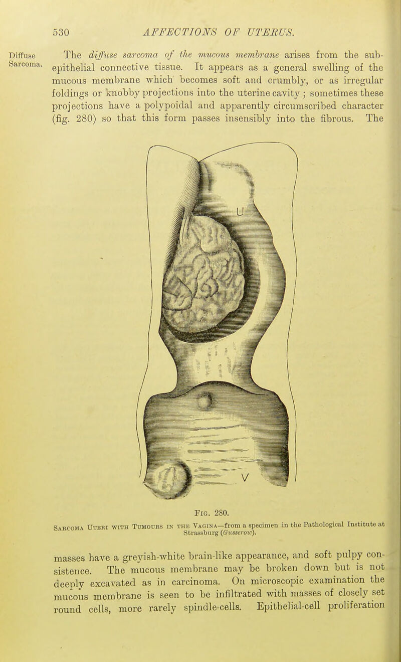 Diffuse Sarcoma. The difftise sarcoma of the mucous membrane arises from the sub- epithelial connective tissue. It appears as a general swelling of the mucous membrane which becomes soft and crumbly, or as irregular foldings or knobby x)ro]ections into the uterine cavity; sometimes these projections have a polypoidal and apparently circumscribed character (fig. 280) so that this form passes insensibly into the fibrous. The Fig. 280. Sarcoma Uteri with Tumours in the Vagina—from a specimen in the Pathological Institute at Strassburg (Gusseroio). masses have a greyish-white brain-like appearance, and soft pulpy con- sistence. The mucous membrane may be broken down but is not deeply excavated as in carcinoma. On microscopic examination the mucous membrane is seen to be infiltrated with masses of closely set round cells, more rarely spindle-cells. Epithelial-cell proliferation