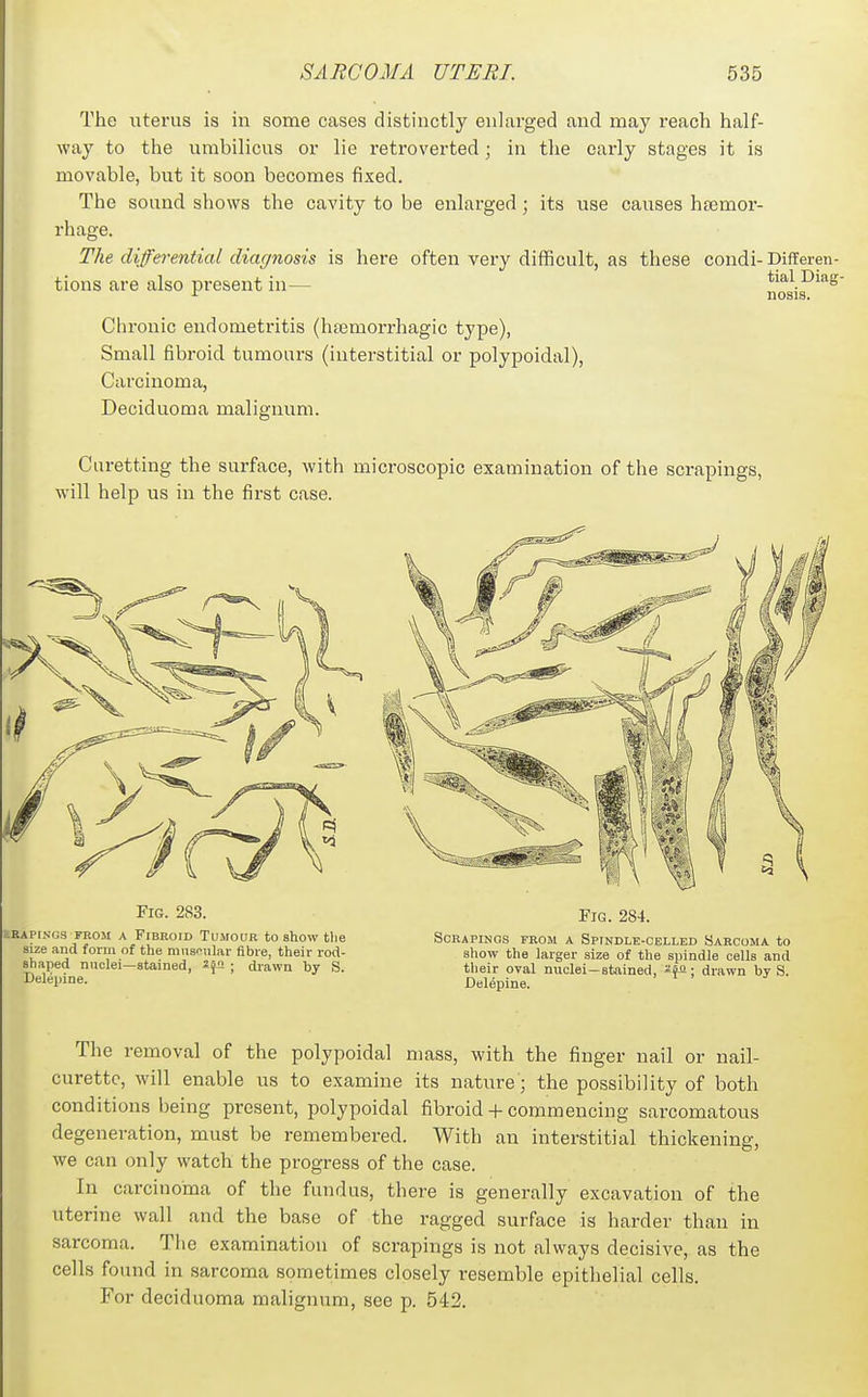 The uterus is in some cases distinctly enlarged and may reach half- way to the umbilicus or lie retroverted; in the early stages it is movable, but it soon becomes fixed. The sound shows the cavity to be enlarged; its use causes haemor- rhage. The diferential diagnosis is here often very difficult, as these condi-Differen tions are also present in— tial Diag- nosis. Chronic endometritis (hfemorrhagic type), Small fibroid tumours (interstitial or polypoidal), Carcinoma, Deciduoma malignum. Curetting the surface, with microscopic examination of the scrapings, will help us in the first case. Fig. 283. RRAPINGS FROM A FiBROID TUMOUR to show the size and foi-m of the miis'^iilar fibre, their rod- shaped nuclei—stained, ; drawn by S. Delepine. Fig. 284. Scrapings from a Spindle-celled Sarcoma to show the larger size of the spindle cells and their oval nuclei—stained, ; drawn by S. Delepine. The removal of the polypoidal mass, with the finger nail or nail- curettc, will enable us to examine its nature; the possibility of both conditions being present, polypoidal fibroid + commencing sarcomatous degeneration, must be remembered. With an interstitial thickening, we can only watch the progress of the case. In carcinoma of the fundus, there is generally excavation of the uterine wall and the base of the ragged surface is harder than in sarcoma. The examination of scrapings is not always decisive, as the cells found in sarcoma sometimes closely resemble epithelial cells. For deciduoma malignum, see p. 542.