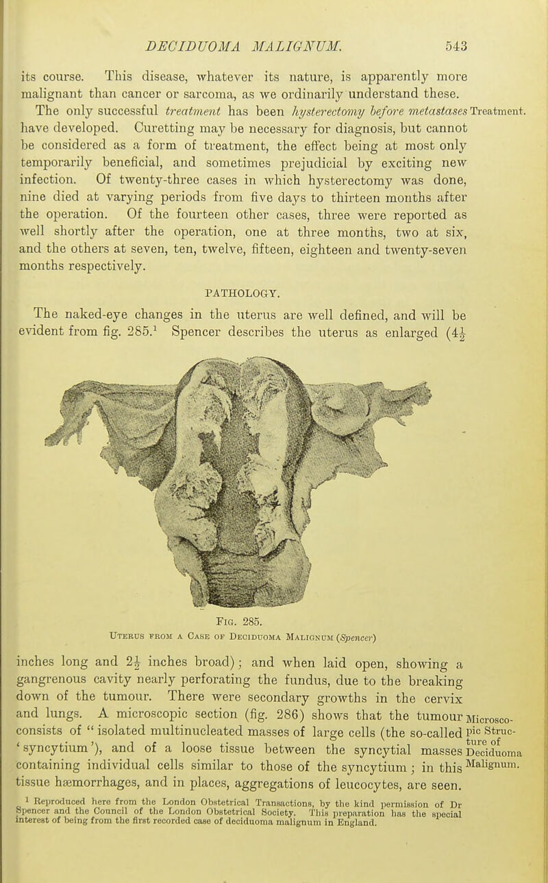 its course. This disease, whatever its nature, is apparently more malignant than cancer or sarcoma, as we ordinarily understand these. The only successful treatvient has been hysterectomy before metastases Treatment, have developed. Curetting may be necessary for diagnosis, but cannot be considered as a form of treatment, the effect being at most only temporarily beneficial, and sometimes prejudicial by exciting new infection. Of twenty-three cases in which hysterectomy was done, nine died at varying periods from five days to thirteen months after the operation. Of the fourteen other cases, three were reported as well shortly after the operation, one at three months, two at six, and the others at seven, ten, twelve, fifteen, eighteen and twenty-seven months respectively. PATHOLOGY. The naked-eye changes in the uterus a,re well defined, and will be evident from fig. 285.^ Spencer describes the uterus as enlarged (4J Fig. 285. Uterus from a Case of Deciduoma Maligndm {Spencer) inches long and 2| inches broad); and when laid open, showing a gangrenous cavity nearly perforating the fundus, due to the breaking down of the tumour. There were secondary growths in the cervix and lungs. A microscopic section (fig. 286) shows that the tumour Microsco- consists of  isolated multinucleated masses of large cells (the so-called P''' Stmc- ' syncytium'), and of a loose tissue between the syncytial masses Dedduoma containing individual cells similar to those of the syncytium ; in this ^^-ligiium. tissue haemorrhages, and in places, aggregations of leucocytes, are seen. 1 Reproduced here from the London Obstetrical Transactions, by the kind permission of Dr Spencer and the Council of the London Obstetrical Society. This preparation lias the special interest of being from the first recorded case of deciduoma malignum in England.