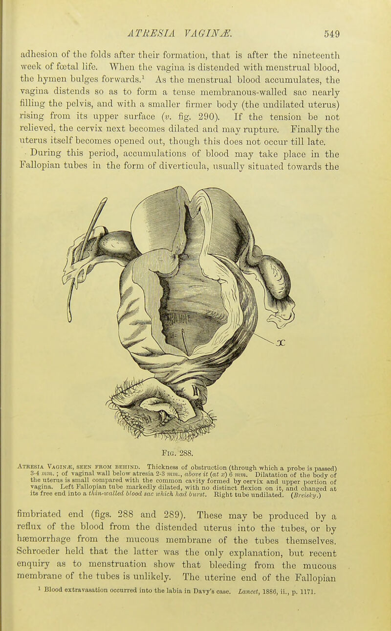 adhesion of the folds after their formation, that is after the nineteenth week of fcetal life. When the vagina is distended with menstrual blood, the hymen bulges forwards.' As the menstrual blood accumulates, the vagina distends so as to form a tense membranous-walled sac nearly- filling the pelvis, and with a smaller firmer body (the undilated uterus) rising from its upper surface (y. fig. 290). If the tension be not relieved, the cervix next becomes dilated and may rupture. Finally the \iterus itself becomes opened out, though this does not occur till late. During this period, accumulations of blood may take place in the Fallopian tubes in the form of diverticula, usually situated towards the Fig. 288. Atresia Vaginae, seen from behind. Thickness of obstniction (through which a probe is passed) 3-4 mm. ; of vaginal wall below atresia 2-3 mm., ahom it {at x) 6 mm. Dilatation of the body of the uterus is small compared with the common cavity formed by cervix and upper portion of vagina. Left Fallopian tube markedly dilated, with no distinct flexion on it, and changed at its free end into a thin-walled blood sac xohich had burst. Bight tube undilated. {Breisky.) fimbriated end (figs. 288 and 289). These may be produced by a reflux of the blood from the distended uterus into the tubes, or by haemorrhage from the mucous membrane of the tubes themselves. Schroeder held that the latter was the only explanation, but recent enquiry as to menstruation show that bleeding from the mucous membrane of the tubes is unlikely. The uterine end of the Fallopian 1 Blood extravasation oconrred into the labia in Davy's case. Lancet, 1886, ii., p. 1171.