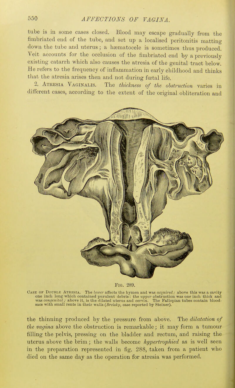 tube is in some cases closed. Blood may escape gradually from the fimbriated end of the tube, and set up a localised peritonitis matting down the tube and uterus; a hajmatocele is sometimes thus produced. Veit accounts for the occlusion of the fimbriated end by a previously existing catarrh which also causes the atresia of the genital tract below. He refers to the frequency of inflammation in early childhood and thinks that the atresia arises then and not during foetal life. 2. Atresia Vaginalis. The thickness of the obstruction varies in different cases, according to the extent of the original obliteration and Fig. 289. Case of Double Atresia. The lower affects the hymen and was acquired: above this was a cavity one inch long which contained purulent debris : the upper obstruction was one inch thick and was congenital; above it, is the dilated uterus and cervix. The Fallopian tubes contain blood- sacs with small rents in their walls (Breiski/, case reported by Steiner). the thinning produced by the pressure from above. The dilatation of the vagina above the obstruction is remarkable; it may form a tumour filling the pelvis, pressing on the bladder and rectum, and raising the uterus above the brim; the walls become hypertrophied as is well seen in the preparation represented in fig. 288, taken from a patient who died on the same day as the operation for atresia was performed.