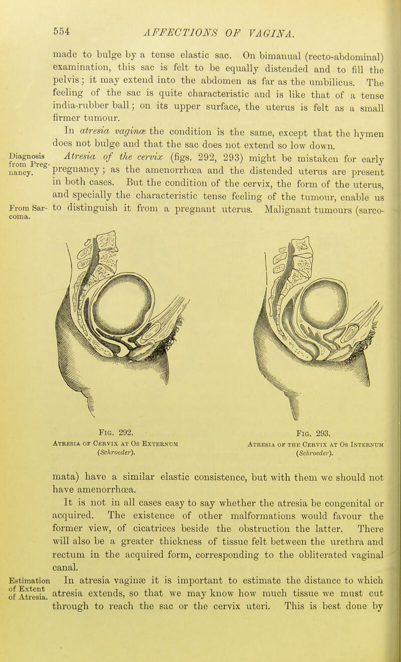 made to bulge by a tense elastic sac. On bimanual (recto-abdominal) examination, this sac is felt to be equally distended and to fill the pelvis; it may extend into the abdomen as far as the umbilicus. The feeling of the sac is quite characteristic and is like that of a tense india-rubber ball; on its upper surface, the uterus is felt as a small firmer tumour. In atresia vagince the condition is the same, except that the hymen does not bulge and that the sac does not extend so low down. Diagnods^ Atresia of the cervix (figs. 292, 293) might be mistaken for early iiaTy. ^^^ P^'^g^<5y 5 as the amenorrho3a and the distended uterus are present in both cases. But the condition of the cervix, the form of the uterus, and specially the characteristic tense feeling of the tumour, enable us From Sar- to distinguish it from a pregnant uterus. Malignant tumours (sarco- coma. ^ Fig. 292. Fig. 293. Atresia of Ceevix at Os Extekndm Atresia of tbe Cervix at Os Internum {Schroeder). (Schroeder). mata) have a similar elastic consistence, but with them we should not have ameuorrhoea. It is not in all cases easy to say whether the atresia be congenital or acquired. The existence of other malformations would favour the former view, of cicatrices beside the obstruction the latter. There will also be a greater thickness of tissue felt between the urethra and rectum in the acquired form, corresponding to the obliterated vaginal canal. Estimation In atresia vaginas it is important to estimate the distance to which of Atresia atresia extends, so that we may know how much tissue we must cut through to reach the sac or the cervix uteri. Tliis is best done by