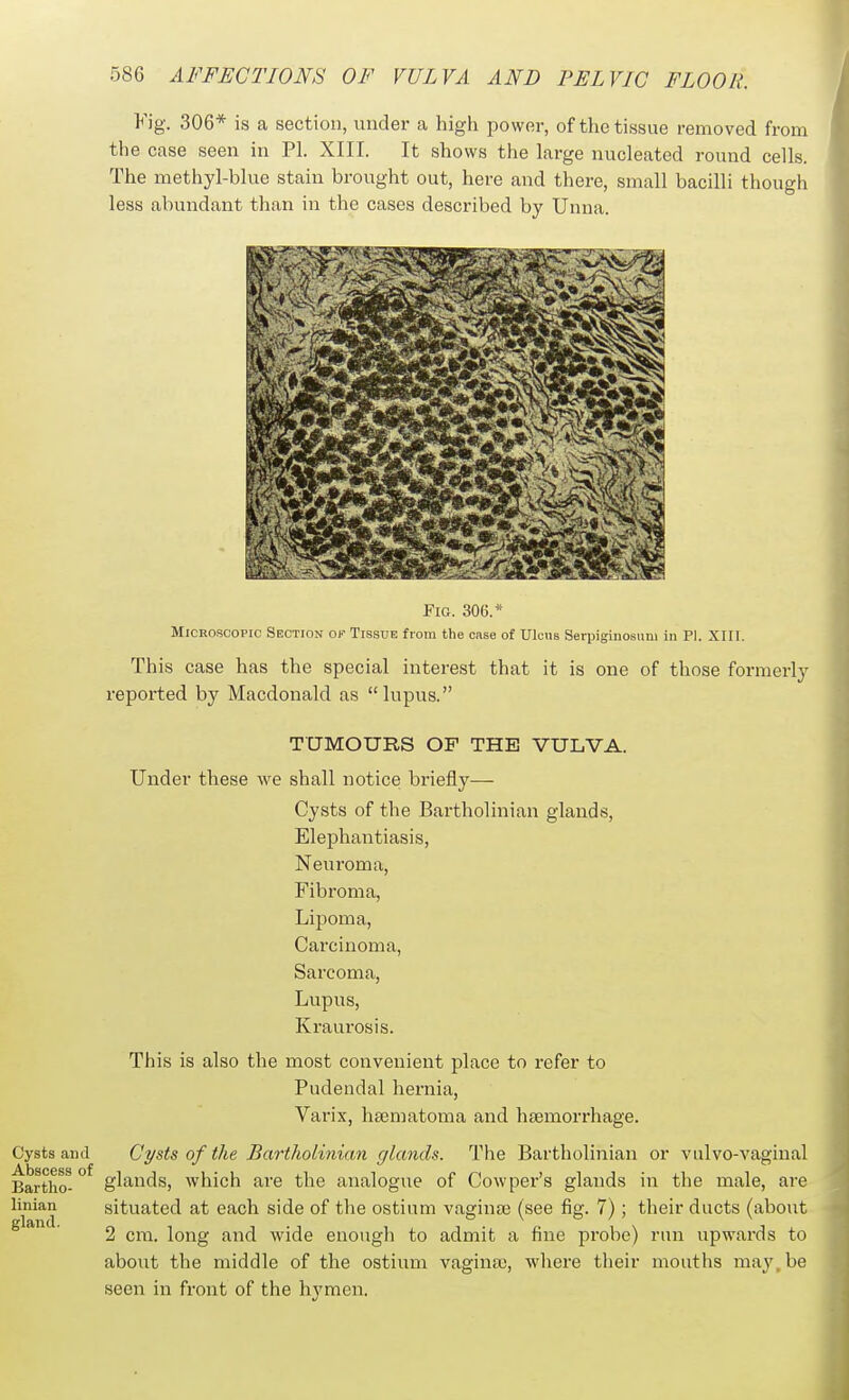 Kig. 306* is a section, under a high power, of the tissue removed from the case seen in PI. XIII. It shows the large nucleated round cells. The methyl-blue stain brought out, here and there, small bacilli though less abundant than in the cases described by Unua. FtG. 306.* Microscopic Section of Tissue from the case of Ulcus Serpiginosum in PI. XIII. This case has the special interest that it is one of those formerly reported by Macdonald as lupus. TUMOURS OF THE VULVA. Under these we shall notice briefly— Cysts of the Bartholinian glands. Elephantiasis, Neuroma, Fibroma, Lipoma, Carcinoma, Sarcoma, Lupus, Kraurosis. This is also the most convenient place to refer to Pudendal hernia, Varix, heematoma and hsemorrhage. Cysts of the Bartholinian glands. The Bartholinian or vnlvo-vaginal glands, which are the analogue of Cowper's glands in the male, are situated at each side of the ostium vaginaj (see fig. 7); their ducts (about 2 cm. long and wide enough to admit a fine probe) run upwards to about the middle of the ostium vagina), where their mouths ma}', be seen in front of the hj'men.