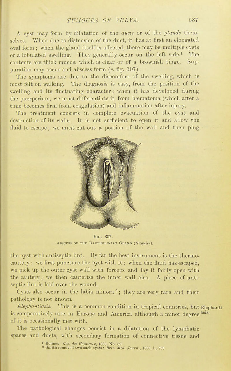 A cyst may form by dilatation of the duds or of the glands them- selves. When due to distension of the duct, it has at first an elongated oval form ; when the gland itself is affected, there may be multiple cysts or a lobulated swelling. They generally occur on the left side.^ The contents ai'e thick mucus, which is clear or of a brownish tinge. Sup- puration may occur and abscess form {v. fig. 307). The symptoms are due to the discomfort of the swelling, which is most felt on walking. The diagnosis is easy, from the position of the swelling and its fluctuating character; when it has developed during the puerperium, we must diflt'erentiate it from heematoma (which after a time becomes firm from coagulation) and inflammation after injury. The treatment consists in complete evacuation of the cyst and destruction of its walls. It is not sufficient to open it and allow the fluid to escape; we must cut out a portion of the wall and then plug Fig. 307. Abscess of thk Bartholinian Gland {Huguici-). the cyst with antiseptic lint. By far the best instrument is the thermo- cautery : we first puncture the cyst with it; when the fluid has escaped, we pick up the outer cyst wall with forceps and lay it fairly open with the cautery; we then cauterise the inner wall also. A piece of anti- septic lint is laid over the wound. Cysts also occur in the labia minora ^; they are very rare and their pathology is not known. Elephantiasis. This is a common condition in tropical countries, but Eleplianti- is comparatively rare in Europe and America although a minor degree of it is occasionally met with. The pathological changes consist in a dilatation of the lymphatic spaces and ducts, with secondary formation of connective tissue and 1 Bonnet—rr(t2. dex IldpHaux, 1888, No. 69. 2 Smith removed two such cysts : Bril. Med. Jov.rn., 1888, i., 250.