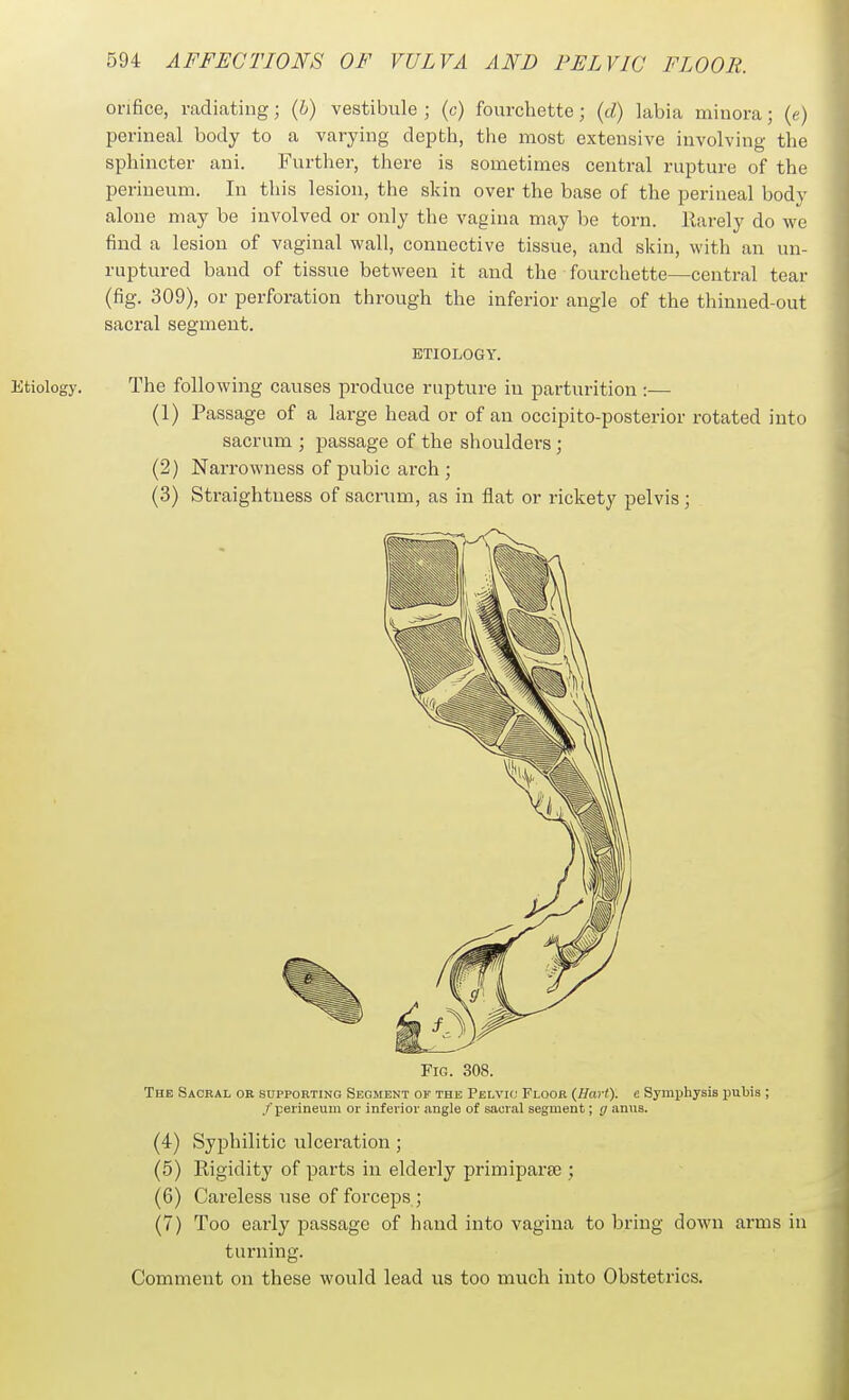 orifice, radiating; {h) vestibule ; (c) fourchette; {d) labia minora; (e) perineal body to a varying depth, the most extensive involving the sphincter ani. Further, there is sometimes central rupture of the perineum. In this lesion, the skin over the base of the perineal body alone may be involved or only the vagina may be torn. Rarely do we find a lesion of vaginal wall, connective tissue, and skin, with an un- ruptured band of tissue between it and the fourchette—central tear (fig. 309), or perforation through the inferior angle of the thinned-out sacral segment. ETIOLOGY. The following causes produce rupture in parturition :— (1) Passage of a large head or of au occipito-posterior rotated into sacrum ; passage of the shoulders; (2) Narrowness of pubic arch ; (3) Straightness of sacriim, as in flat or rickety pelvis; Fig. 308. The Sacral or supporting Segment of the Pelvic Floor {Hart), e Symphysis pubis ; /'perineum or inferior angle of sacral segment; g anus. (4) Syphilitic ulcei-ation ; (5) Rigidity of parts in elderly primiparse ; (6) Careless use of forceps; (7) Too eai-ly passage of hand into vagina to bring down arms in turning. Comment on these would lead us too much into Obstetrics.