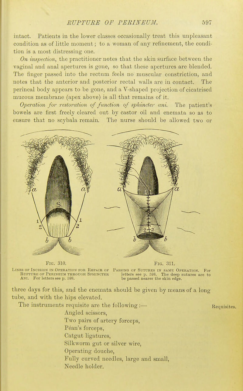 intact. Patients in the lower classes occasionally treat this unpleasant condition as of little moment; to a woman of any refinement, the condi- tion is a most distressing one. On insjjection, tlie practitioner notes that the skin surface between the vaginal and anal apertures is gone, so that these apertures are blended. The finger passed into the rectum feels no muscular constriction, and notes that the anterior and posterior rectal walls are in contact. The perineal body appears to be gone, and a V-shaped projection of cicatrised mucous membrane (apex above) is all that remains of it. Operation for restoration of friction of sphincter ani. The patient's bowels are first freely cleared out by castor oil and enemata so as to ensure that no scybala remain. The nurse should be allowed two or Fig. 310. Fig. 311. LisEs or Incision in Operation for Repair ok Passing of Sutures in same Operation. For Rupture of Perineum through Sphincter letters see p. 598. The deep sutures are to Ani. For letters see p. 598. be iiassed nearer the skin edge. three days for this, and the enemata should be given by means of a long tube, and with the hips elevated. The instruments requisite are the following :— Requisites. Angled scissors, Two pairs of artery forceps, Pean's forceps. Catgut ligatures. Silkworm gut or silver wire, Operating douche, Fully curved needles, large and small, Needle holder.