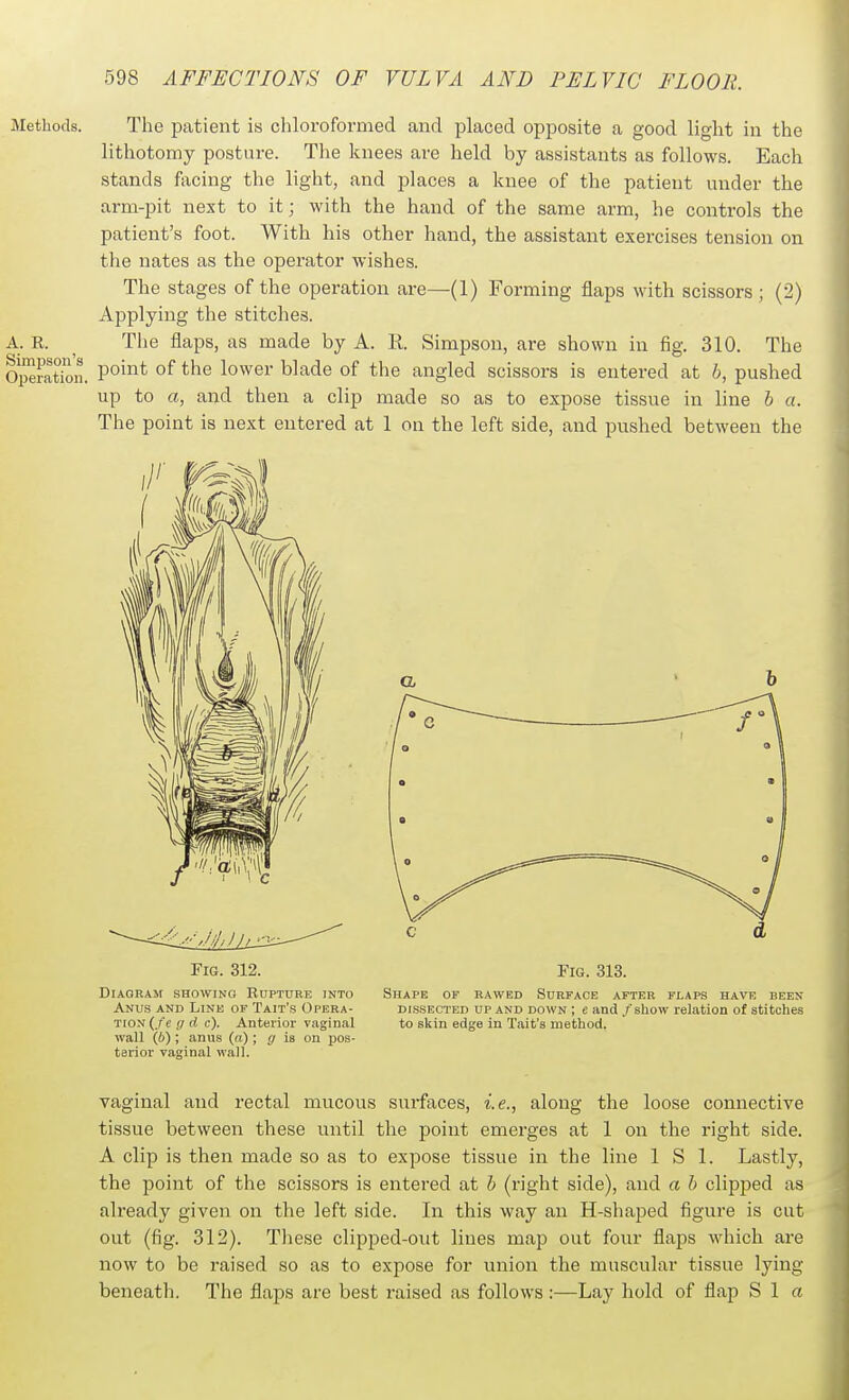 Methods. The patient is chloroformed and placed opposite a good light in the lithotomy posture. The knees are held by assistants as follows. Each stands fticing the light, and places a knee of the patient under the arm-pit nest to it; with the hand of the same arm, he controls the patient's foot. With his other hand, the assistant exercises tension on the nates as the operator wishes. The stages of the operation are—(1) Forming flaps with scissors ; (2) Applying the stitches. A. R. ^ The flaps, as made by A. R. Simpson, are shown in fig. 310. The Oi^fatioii. P^^'^^ \o\yeY blade of the angled scissors is entered at h, pushed up to a, and then a clip made so as to expose tissue in line h a. The point is next entered at 1 on the left side, and pushed between the Fig. 312. Fig. 313. Diagram showing Rupture into Shape of rawed Surface after flaps have been Anus and Line of Tait's Opera- dissected up and down ; e and /show relation of stitches tion (/e g d c). Anterior vaginal to skin edge in Tait's method, wall (i); anus (a); g is on pos- terior vaginal wall. vaginal and rectal mucous surfaces, i.e., along the loose connective tissue between these until the point emerges at 1 on the right side. A clip is then made so as to expose tissue in the line 1 S 1. Lastly, the point of the scissors is entei-ed at h (right side), and a h clipped as already given on the left side. In this way an H-shaped figure is cut out (fig. 312). These clipped-out lines map out four flaps which are now to be raised so as to expose for union the muscular tissue lying beneath. The flaps are best raised as follows :—Lay hold of flap S 1 a