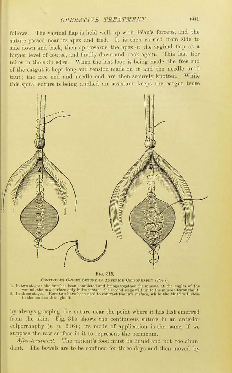 follows. The vaginal flap is held well up with Pean's forceps, and the suture passed near its apex and tied. It is then carried from side to side down and back, then up towards the apex of the vaginal flap at a higher level of course, and finally down and back again. This last tier takes in the skin edge. When the last loop is being made the free end of the catgut is kept long and tension made on it and the needle until taut; the free end and needle end are then securely knotted. While this spiral suture is being applied an assistant keeps the catgut tense Fig. 315. Continuous Catgut Suture in Anterior Colporraphy (Pozzi). 1. In two stages : the first has been completed and brings together the mucosa at the angles of the wound, the raw surface only in its centre ; the second stage will unite the mucosa tliroughout. 2. In three stages. Here two have been used to contract the raw surface, while the third will close in the mucosa throughout. by always grasping the suture near the point where it has last emerged from the skin. Fig. 315 shows the continuous sutiu-e in an anterior colporrhaphy {v. p. 616); its mode of application is the same, if we suppose the raw surface in it to represent the perineum. After-treatment. The patient's food must be liquid and not too abun- dant. The bowels are to be confined for three days and then moved by