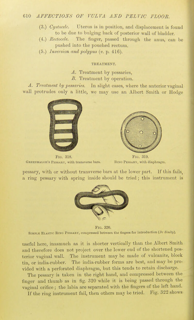 (3.) Cystocelc. Uterus is in jjosition, and displacement is found to be due to bulging back of posterior wall of bladder. (4.) Rectocele. The finger, passed through the anus, can be pushed into the pouched rectum. (5.) Inversion and'polypus (v. p. 416). TREATMENT. A. Treatment by pessaries, £. Treatment by operation. A. Treatment hy pessaries. In slight cases, where the anterior vaginal wall protrudes only a little, we may use an Albert Smith or Hodge Tig. 318. Fig. 319. Grebnhalgh's Pkssahy, with transverse bars. Ring Pessary, with diaphragm. pessary, with or without transverse bars at the lower part. If this fails, a ring pessary with spring inside should be tried; this instrument is Fig. 320. Simple Elastic Ring Pessaky, compressed between the fingers for introduction (23c Sinety). useful here, inasmuch as it is shorter vertically than the Albert Smith and therefore does not project over the lower end of the shortened pos- terior vaginal wall. The instrument may be made of vulcanite, block tin, or india-rubber. The india-rubber forms are best, and may be pro- vided with a perforated diaphragm, but this tends to retain discharge. The pessary is taken in the right hand, and compressed between tlie finger and thumb as in fig. 320 while it is being passed through the vaginal orifice ; the labia are separated witli the fingers of the left hand. If the ring instrument fail, then others may be tried. Fig. 322 shows