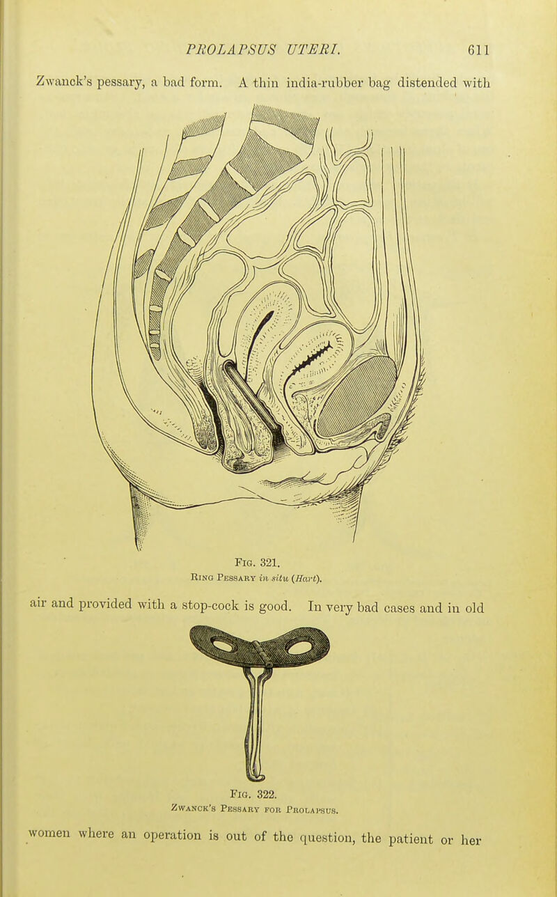 Zwanok's pessary, a bad form. A thin india-rubber bag distended with Fig. 321. Ring Pbssary in situ (Hart). ir and provided with a stop-cock is good. In very bad cases and in old Fig. 322. ZwaNCK's PbsSAHY for PnOLAl'SUS. women where an operation is out of the question, the patient or her