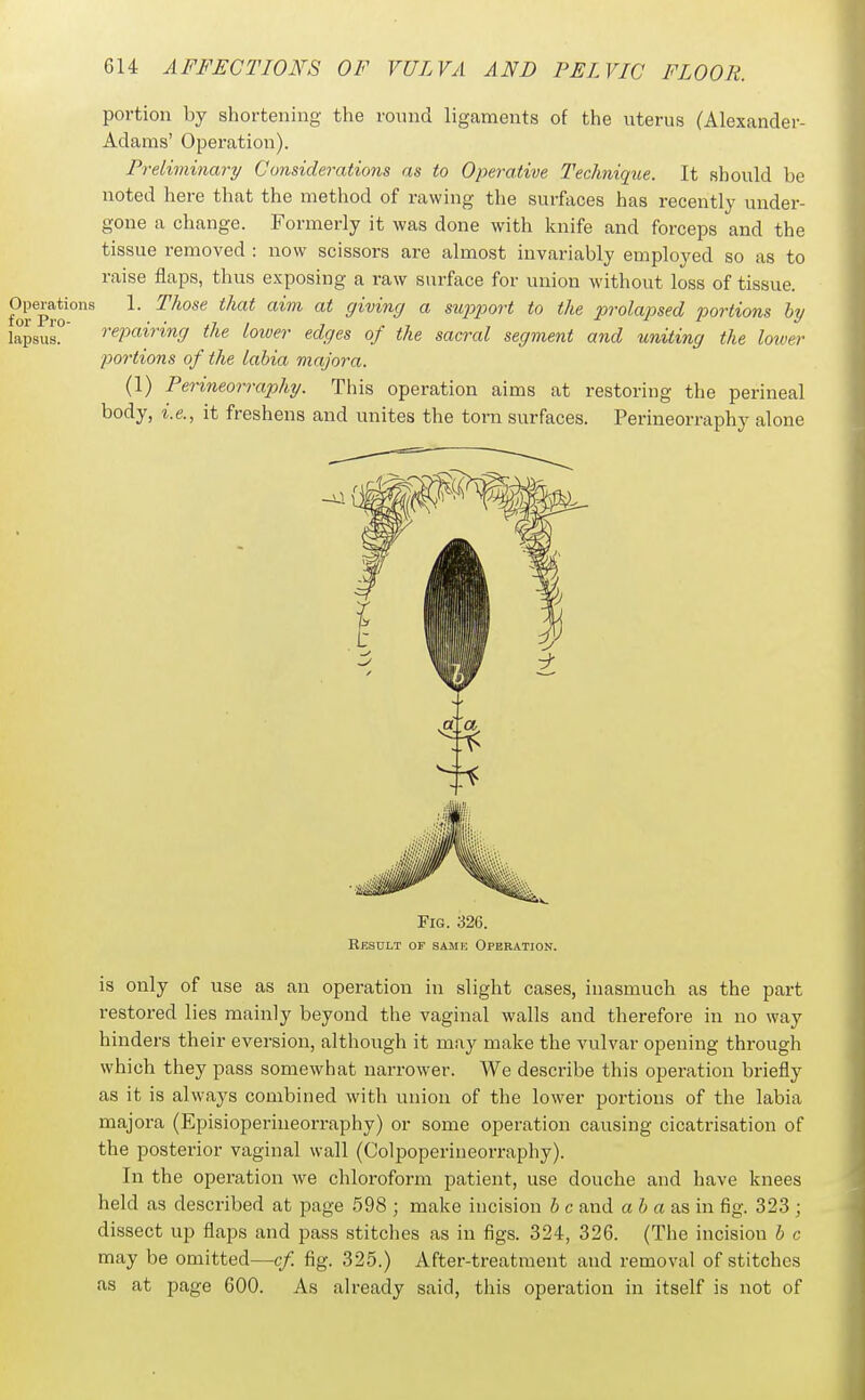 portion by shortening the round ligaments of the uterus (Alexander- Adams' Operation). Preliminary Considerations as to Operative J'echnique. It should be noted here that the method of rawing the surfaces has recently under- gone a change. Formerly it was done with knife and forceps and the tissue removed : now scissors are almost invariably employed so as to raise flaps, thus exposing a raw surface for union without loss of tissue. Operations 1. Those that aim at giving a supjwrt to the prolapsed portions hy lapsus? repairing the loiver edges of the sacral segment and uniting the lowei- portions of the labia majora. (1) Perineorraphy. This operation aims at restoring the perineal body, i.e., it freshens and unites the torn surfaces. Perineorraphy alone Fig. 326. Result of same Operation. is only of use as an operation in slight cases, inasmuch as the part restored lies mainly beyond the vaginal walls and therefore in no way hinders their eversion, although it may make the vulvar opening through which they pass somewhat narrower. We describe this operation briefly as it is always combined with union of the lower portions of the labia majora (Episioperineorraphy) or some operation causing cicatrisation of the posterior vaginal wall (Colpoperineorraphy). In the operation we chloroform patient, use douche and have knees held as described at page 598 ; make incision b c and a i» a as in fig. 323 ; dissect up flaj^s and pass stitches as in figs. 324, 326. (The incision b c may be omitted—cf. fig. 325.) After-treatment and removal of stitches as at page 600. As already said, this operation in itself is not of