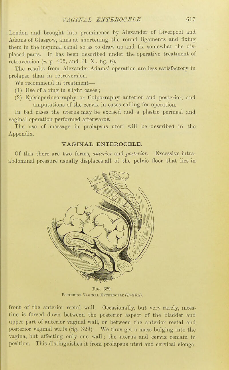 London and brought into prominence by Alexander of Liverpool and Adams of Glasgow, aims at shortening the round ligaments and fixing them in the inguinal canal so as to draw up and fix somewhat the dis- placed parts. It has been described under the operative treatment of retroversion {v. p. 405, and PI. X., fig. 6). The results from Alexander-Adams' operation are less satisfactory in prolapse than in retroversion. We recommend in treatment— (1) Use of a ring in slight cases; (2) Episioperineorraphy or Colporraphy anterior and posterior, and amputations of the cervix in cases calling for operation. In bad cases the uterus may be excised and a plastic perineal and vaginal operation performed afterwards. The iTse of massage in prolapsus uteri will be described in the Appendix. VAGINAL BNTBROCBLB. Of this there are two forms, anterior and loosterior. Excessive intra- abdominal pressure usually displaces all of the pelvic floor that lies in Fig. 329. Posterior Vaoinal Enterocele (Breishy). front of the anterior rectal wall. Occasionally, but very rarely, intes- tine is forced down between the posterior aspect of the bladder and upper part of anterior vaginal wall, or between the anterior rectal and posterior vaginal walls (fig. 329). We thus get a mass bulging into the vagina, but affecting only one wall; the uterus and cervix remain in position. This distinguishes it from prolapsus uteri and cervical elonga-