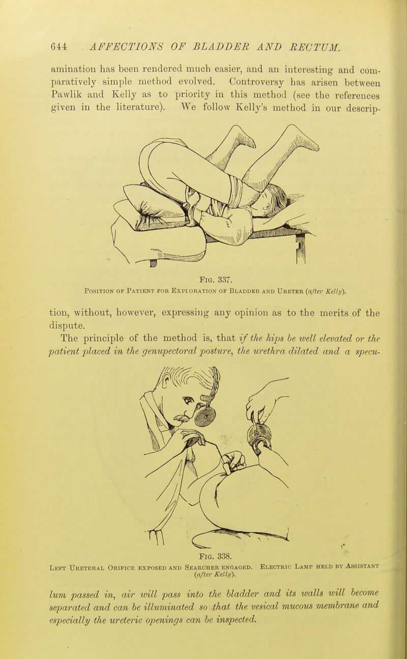 amination has been rendered much easier, and an interesting and com- paratively simple method evolved. Controversy has arisen between Pavvlik and Kelly as to priority in this method (see the references given in the literature). We follow Kelly's method in our descrip- FiG. 337. Position of Patient for Exploration of Bladder and Ureter {aftn- Kelly). tion, without, however, expressing any opinion as to the merits of the dispute. The principle of the method is, that if the hijis he ivell elevated or the patient placed in the genupectoral posture, the urethra dilated and a specu- FiG. 338. Left' Ureteral Orifice exposed and Searcher enoaoed. Electric Lamp held by Assistant (a/(e)' Kdly). lum passed in, air ivill pass into the bladder and its walls will become separated and can be ilktminaied so that the vesical mucous membrane and especially the ureteric ojyenings can be ins2jected.